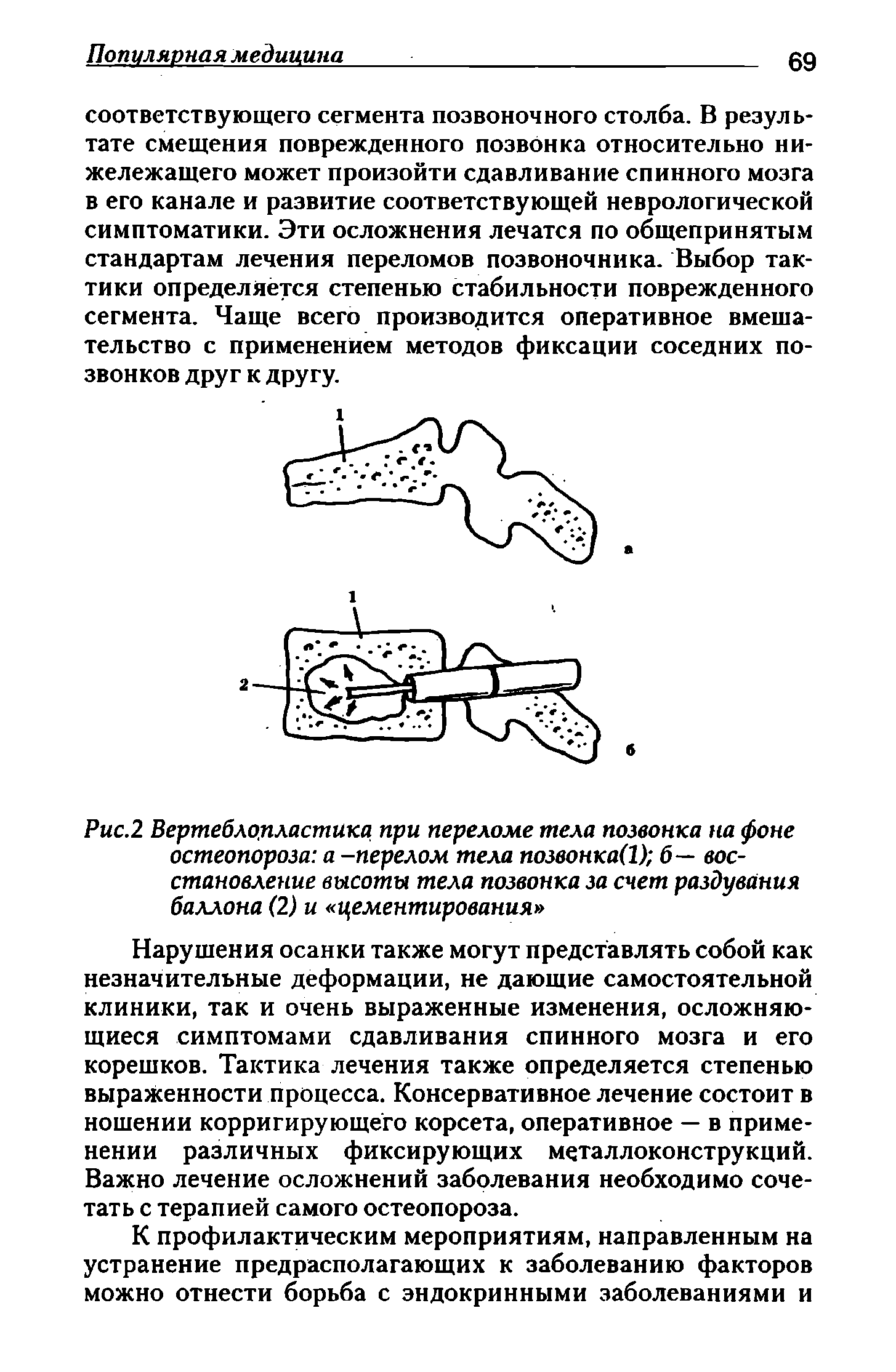 Рис.2 Вертеблопластика при переломе тела позвонка на фоне остеопороза а -перелом тела позвонка(1) б— восстановление высоты тела позвонка за счет раздувания баллона (2) и цементирования ...