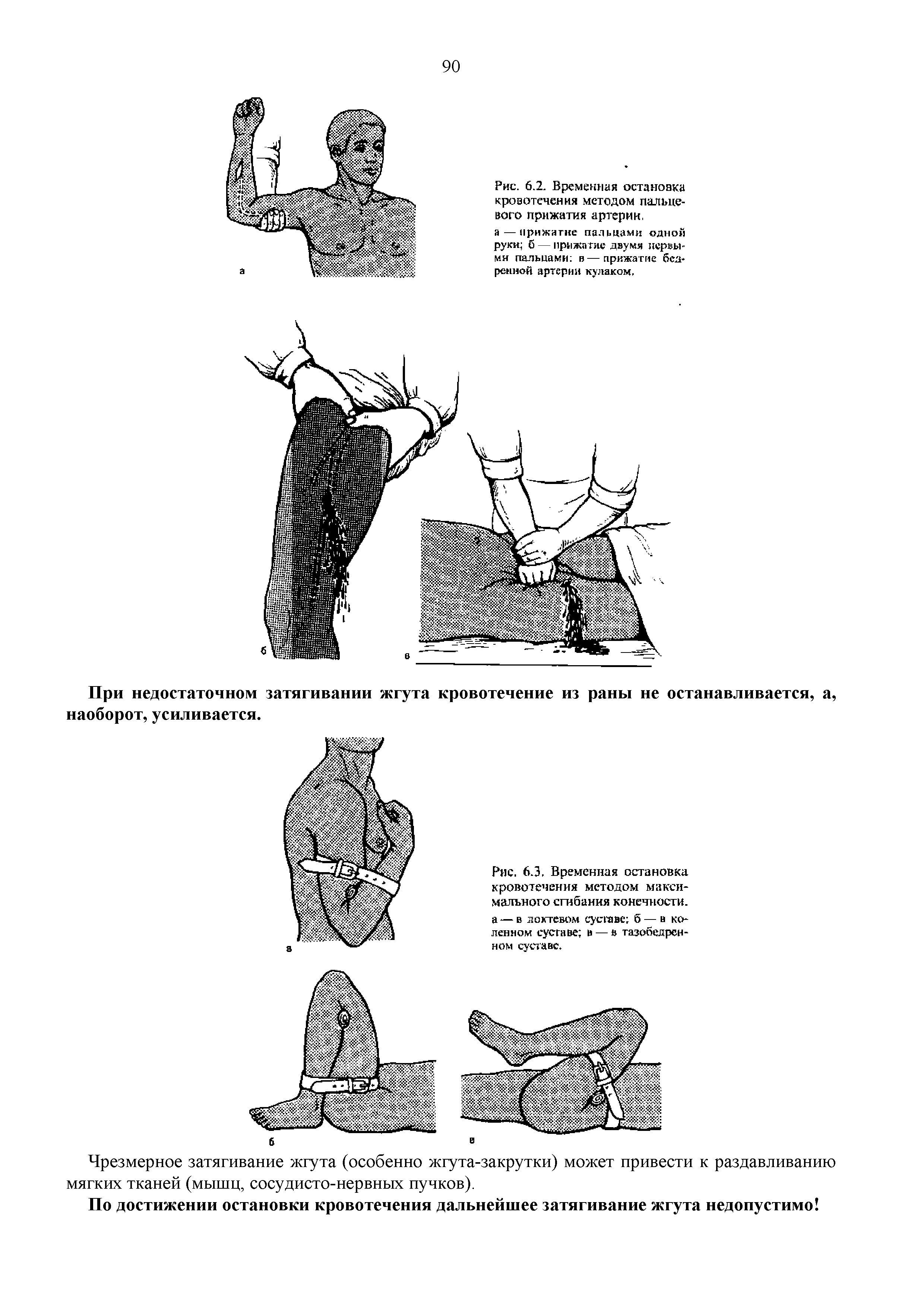 Рис. 6.3. Временная остановка кровотечения методом максимального сгибания конечности, а — в локтевом сусгаве б — в коленном сусгаве в — в тазобедренном суставе.