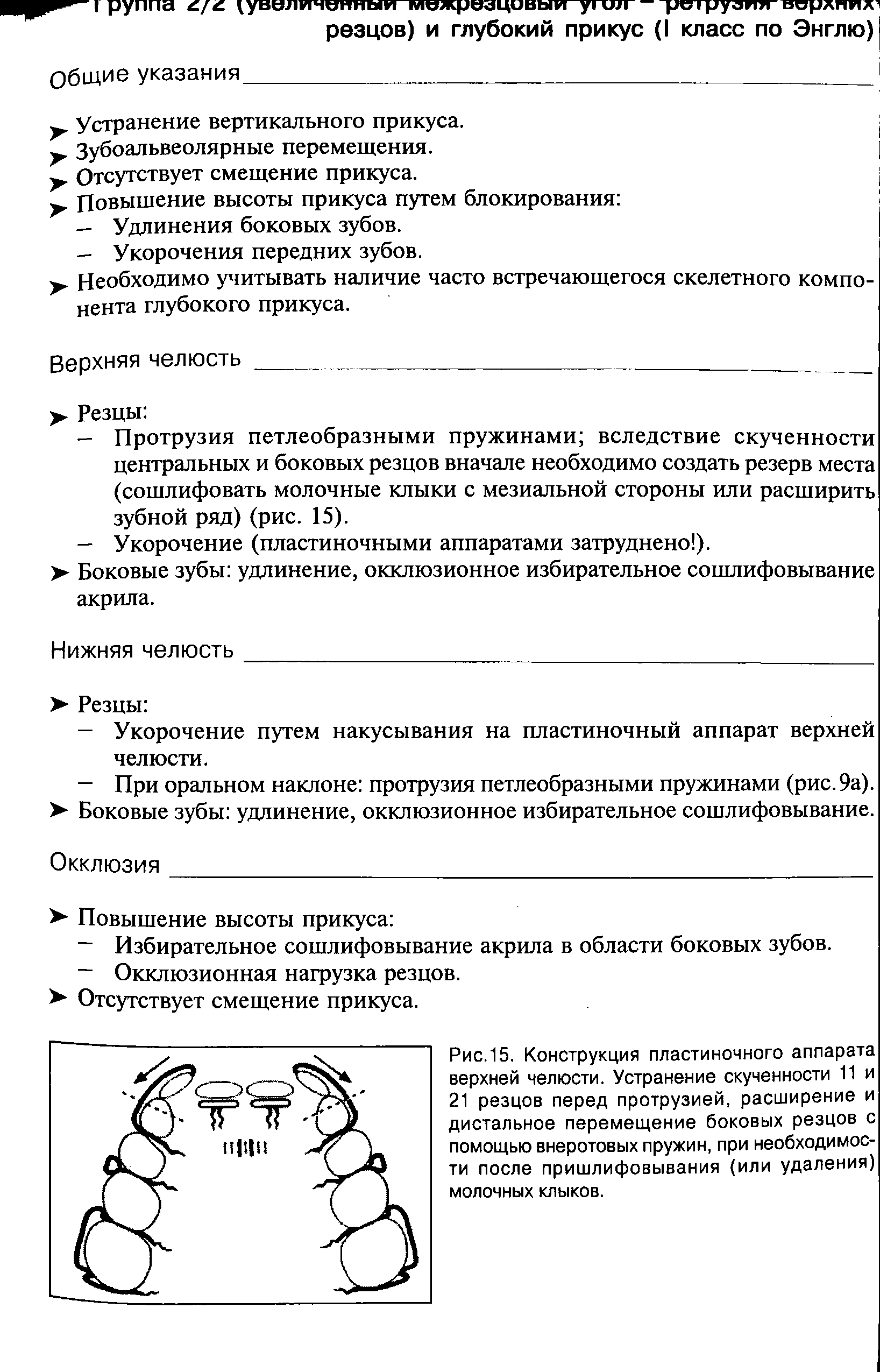 Рис.15. Конструкция пластиночного аппарата верхней челюсти. Устранение скученности 11 и 21 резцов перед протрузией, расширение и дистальное перемещение боковых резцов с помощью внеротовых пружин, при необходимости после пришлифовывания (или удаления) молочных клыков.