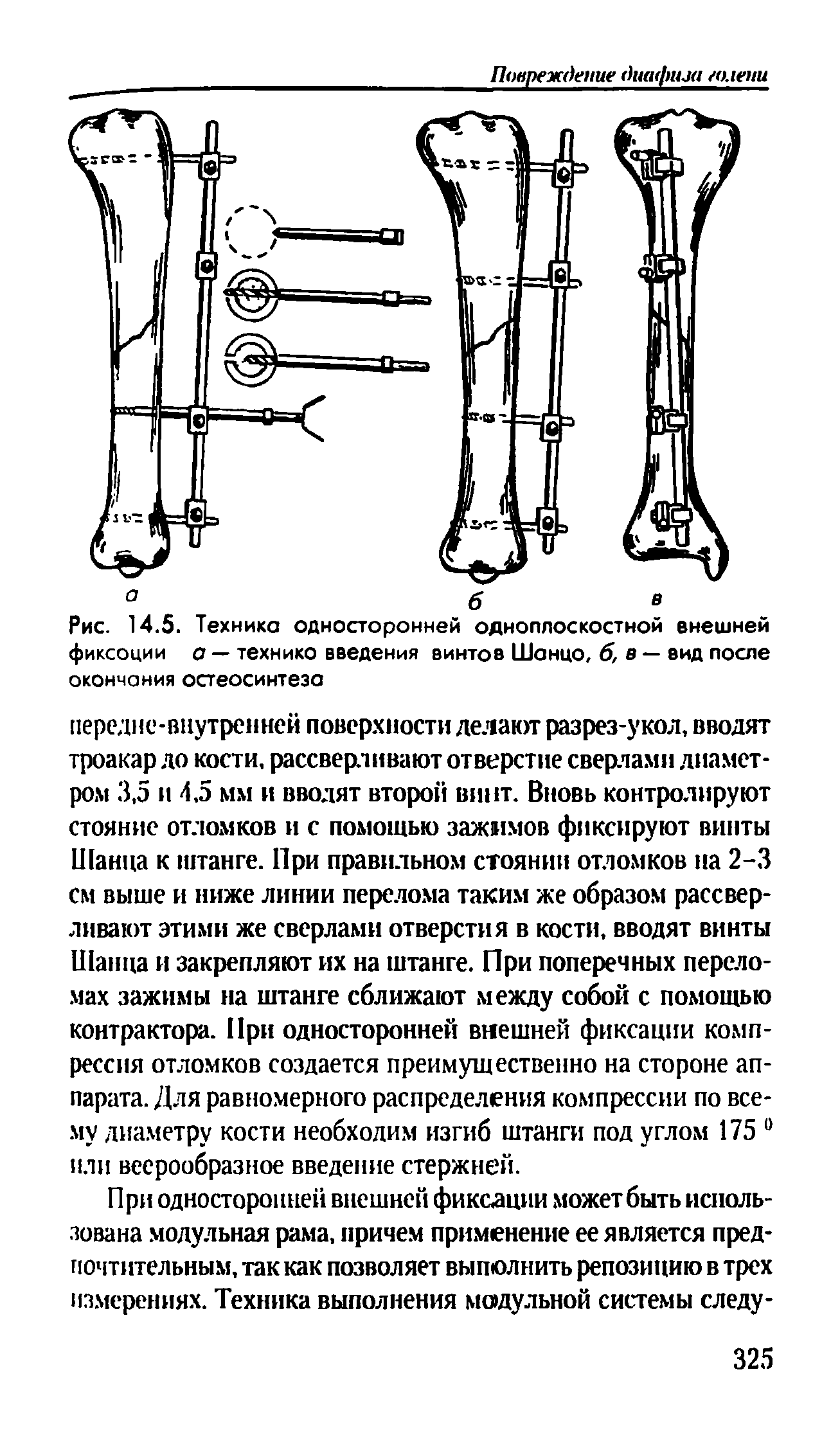 Рис. 14.5. Техника односторонней одноплоскостной внешней фиксоции а — технико введения винтов Шанцо, б, в — вид после окончания остеосинтеза...