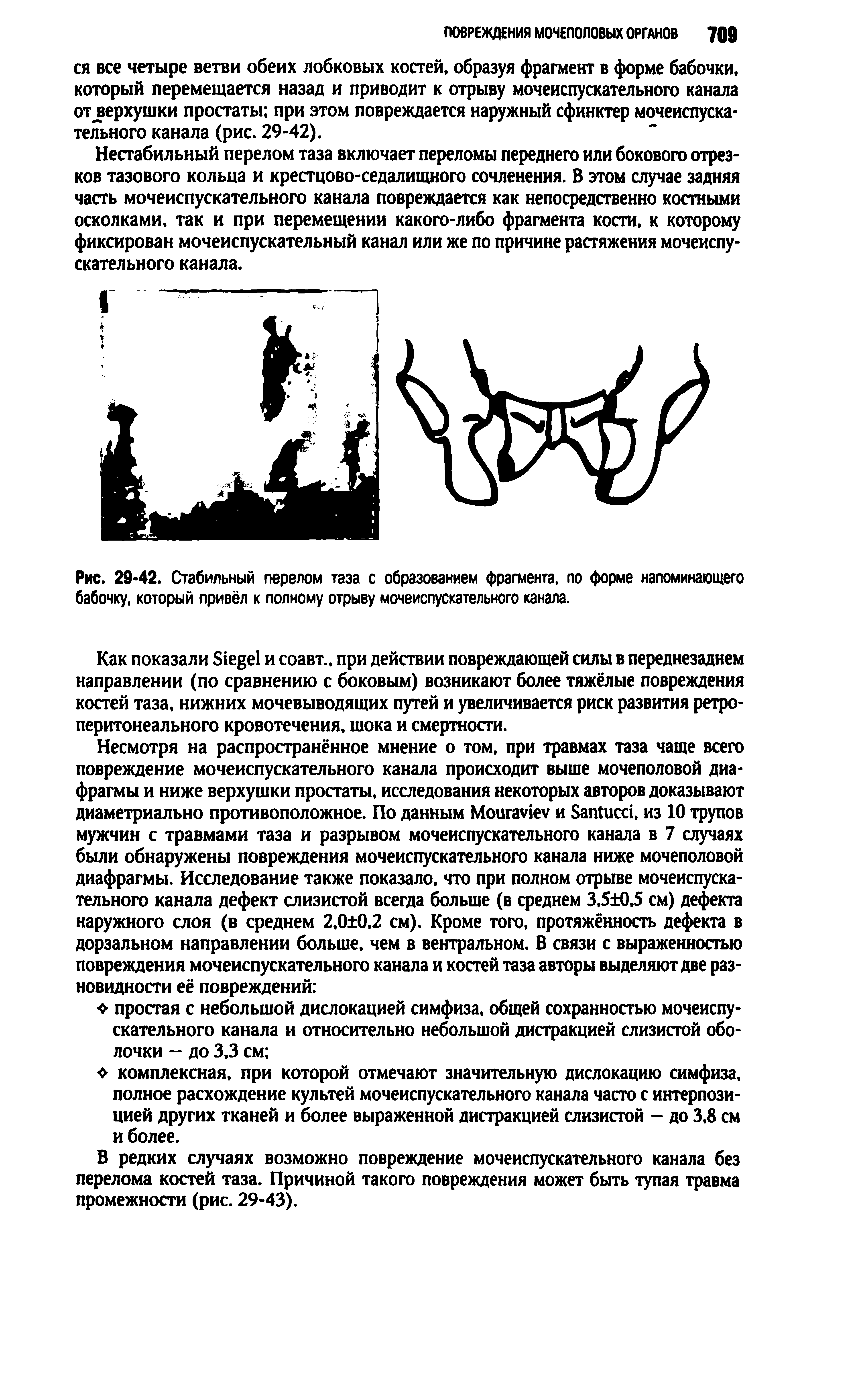 Рис. 29-42. Стабильный перелом таза с образованием фрагмента, по форме напоминающего бабочку, который привёл к полному отрыву мочеиспускательного канала.