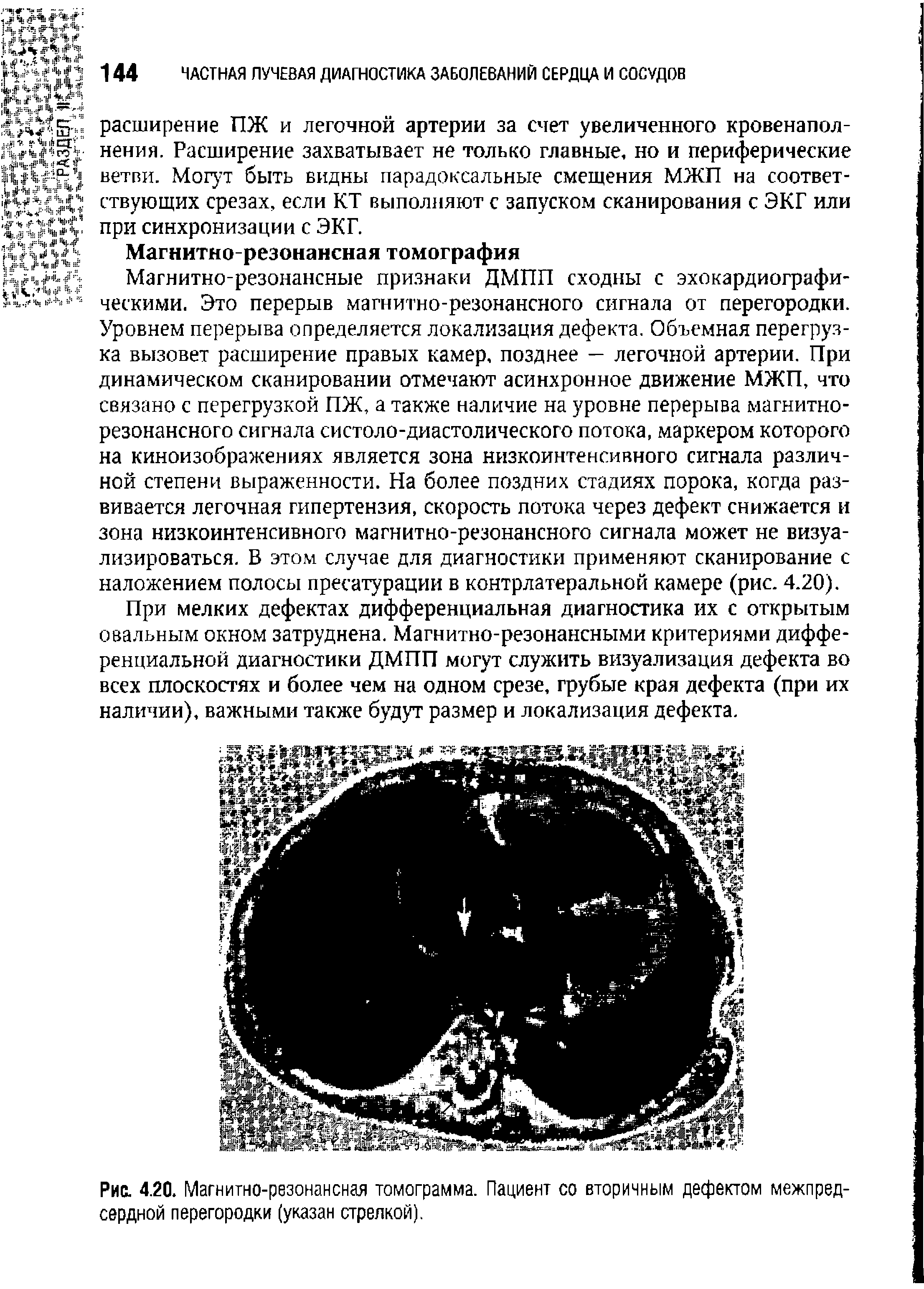 Рис. 4.20. Магнитно-резонансная томограмма. Пациент со вторичным дефектом межпредсердной перегородки (указан стрелкой).