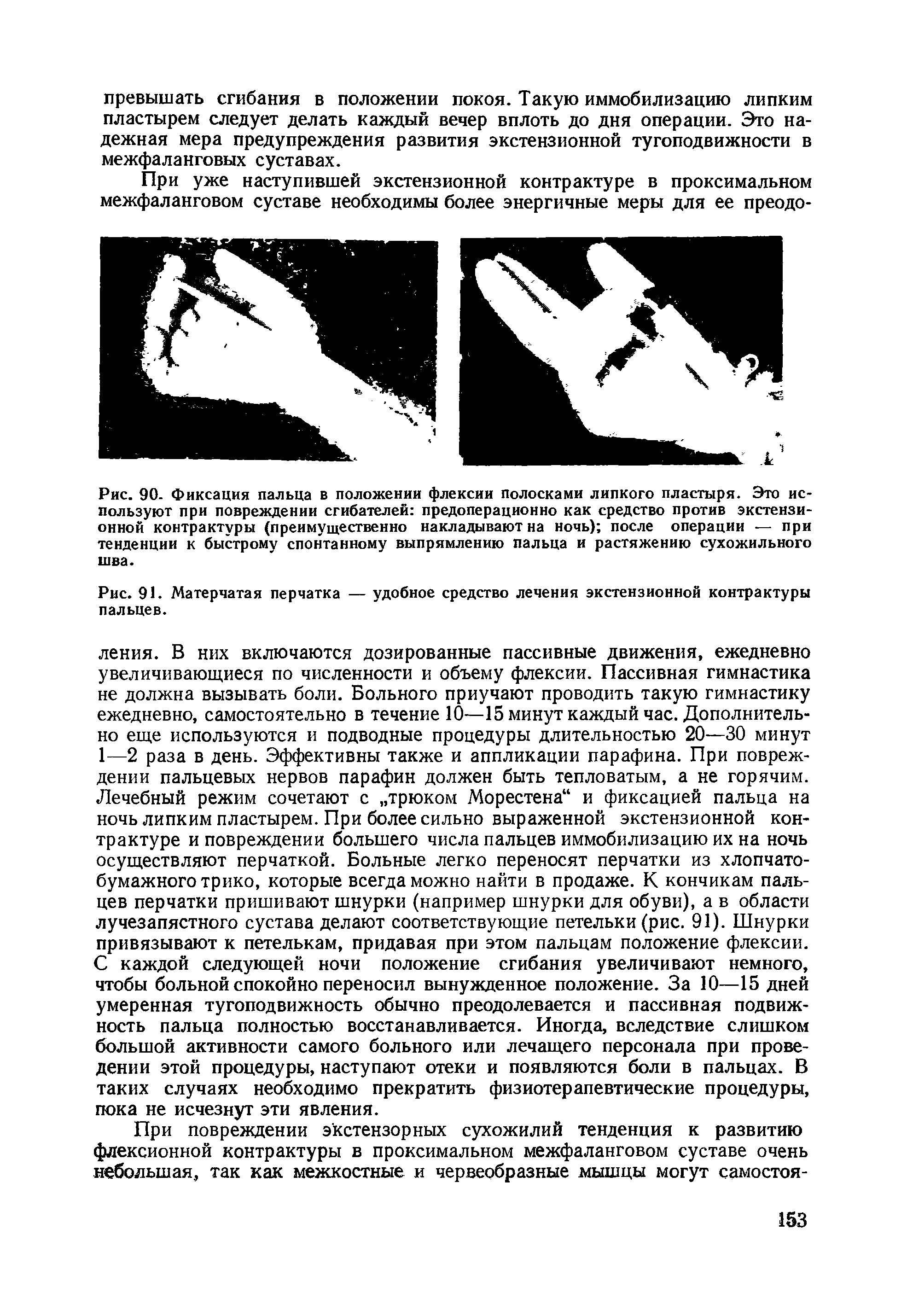 Рис. 90. Фиксация пальца в положении флексии полосками липкого пластыря. Это используют при повреждении сгибателей предоперационно как средство против экстензионной контрактуры (преимущественно накладывают на ночь) после операции — при тенденции к быстрому спонтанному выпрямлению пальца и растяжению сухожильного шва.