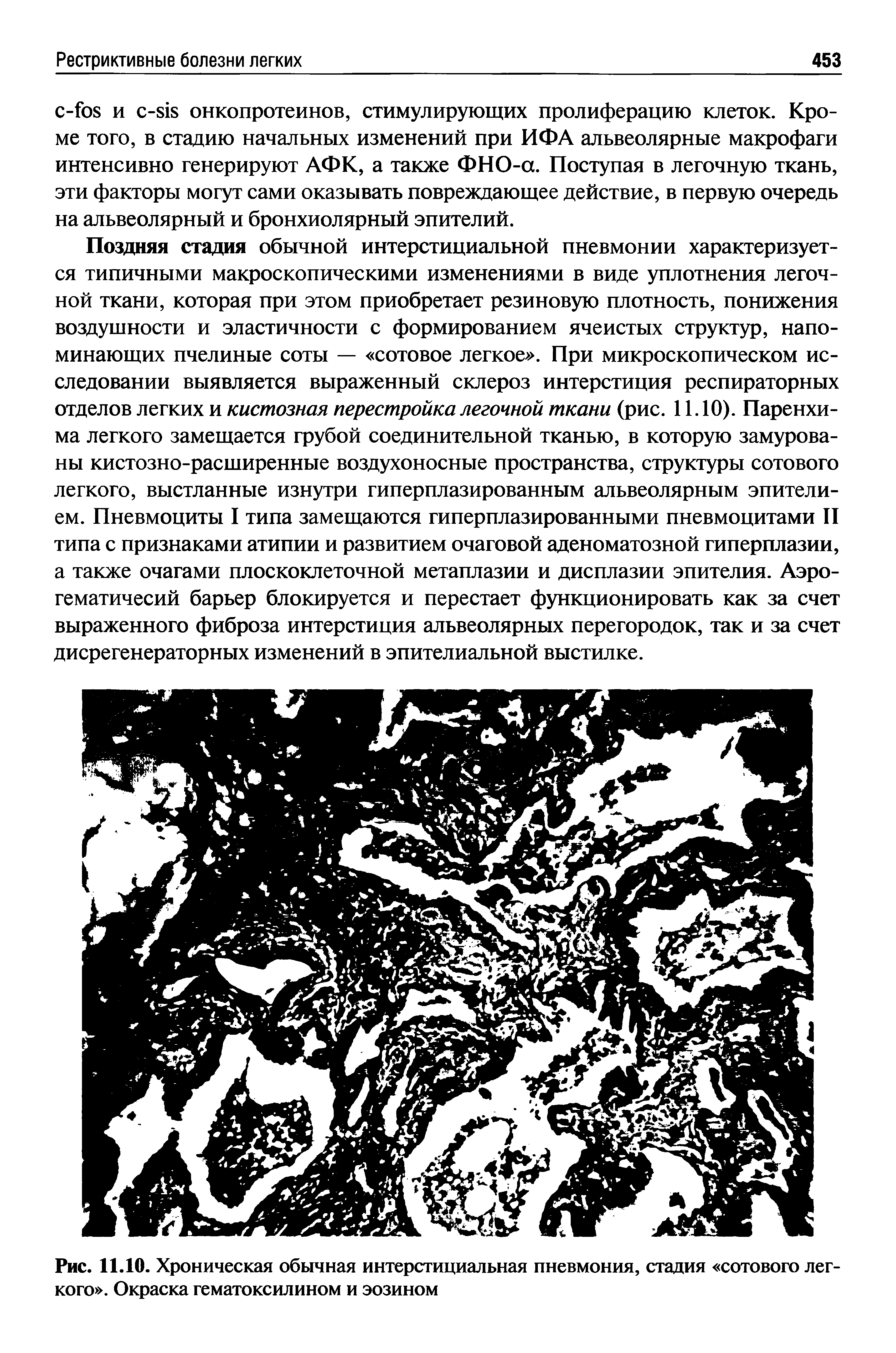 Рис. 11.10. Хроническая обычная интерстициальная пневмония, стадия сотового легкого . Окраска гематоксилином и эозином...