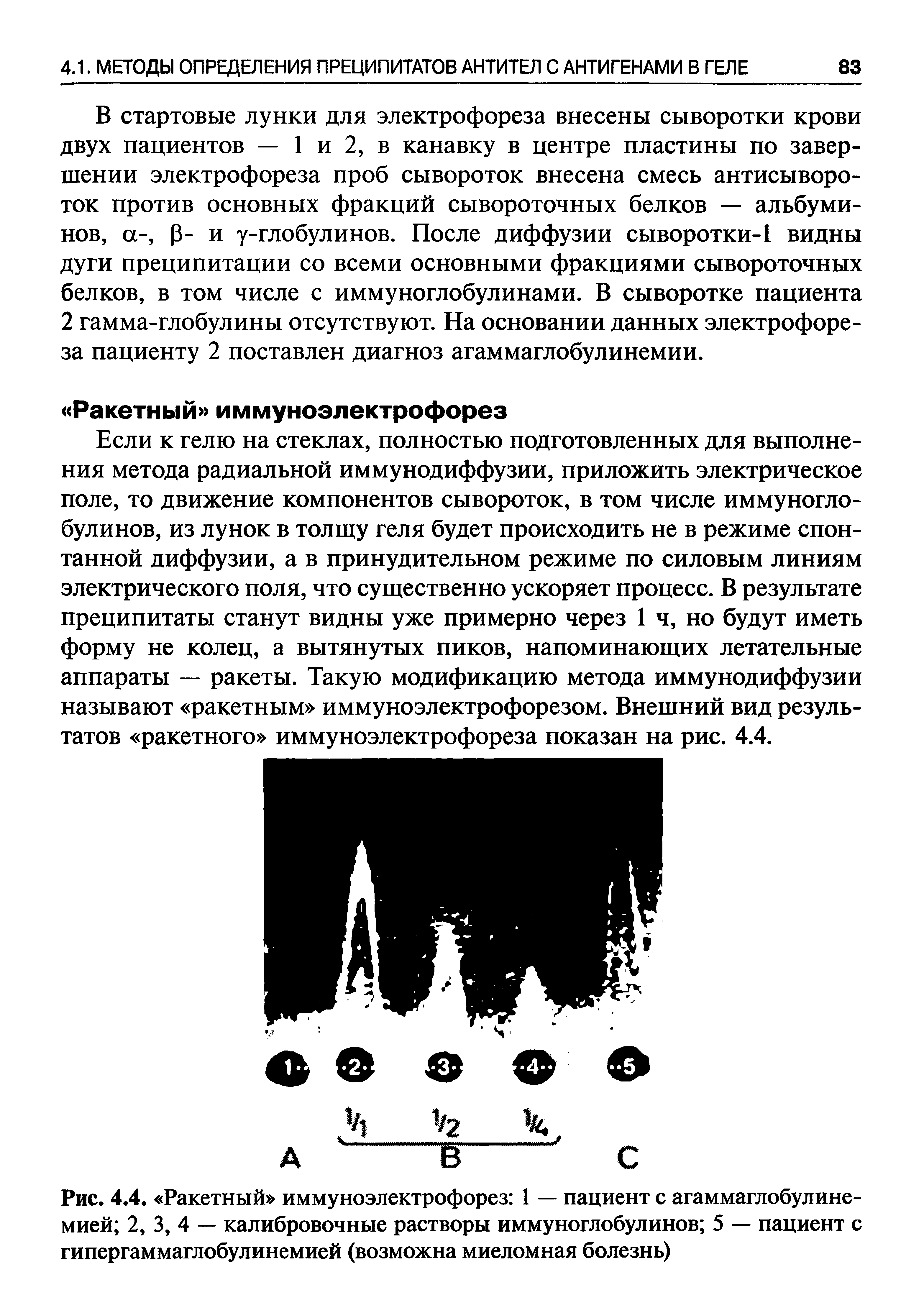 Рис. 4.4. Ракетный иммуноэлектрофорез 1 — пациент с агаммаглобулинемией 2, 3, 4 — калибровочные растворы иммуноглобулинов 5 — пациент с гипергаммаглобулинемией (возможна миеломная болезнь)...