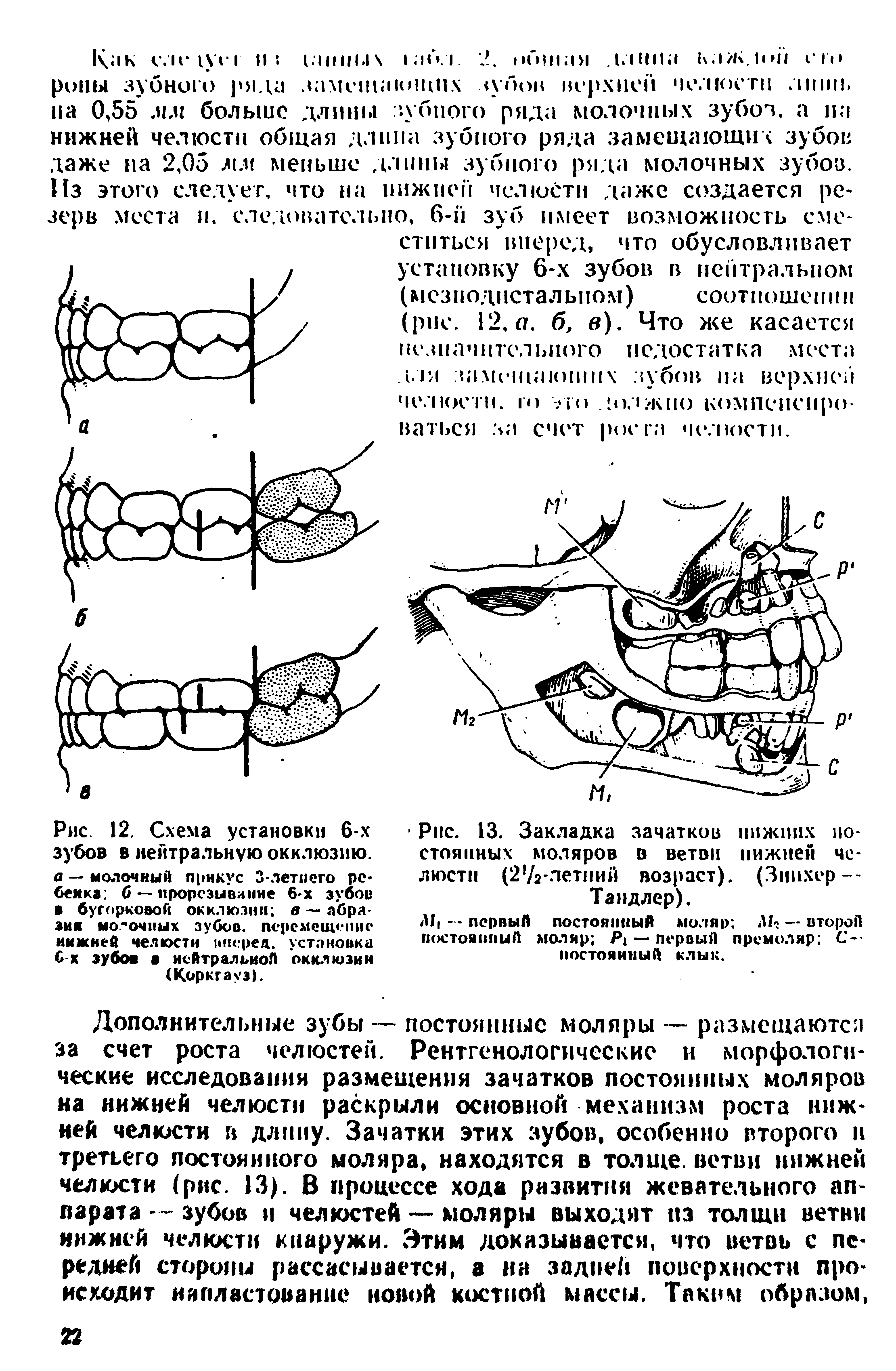 Рис. 12. Схема установки 6-х зубов в нейтральную окклюзию. а — молочный прикус 3-летпего рс бейка б — прорезывание 6-х зубов бугорковой окклюзии в — абразия мо"очных зубов, перемещение имжней челюсти ипсред. установка С-х зубов в нейтральной окклюзии (Коркгауэ).