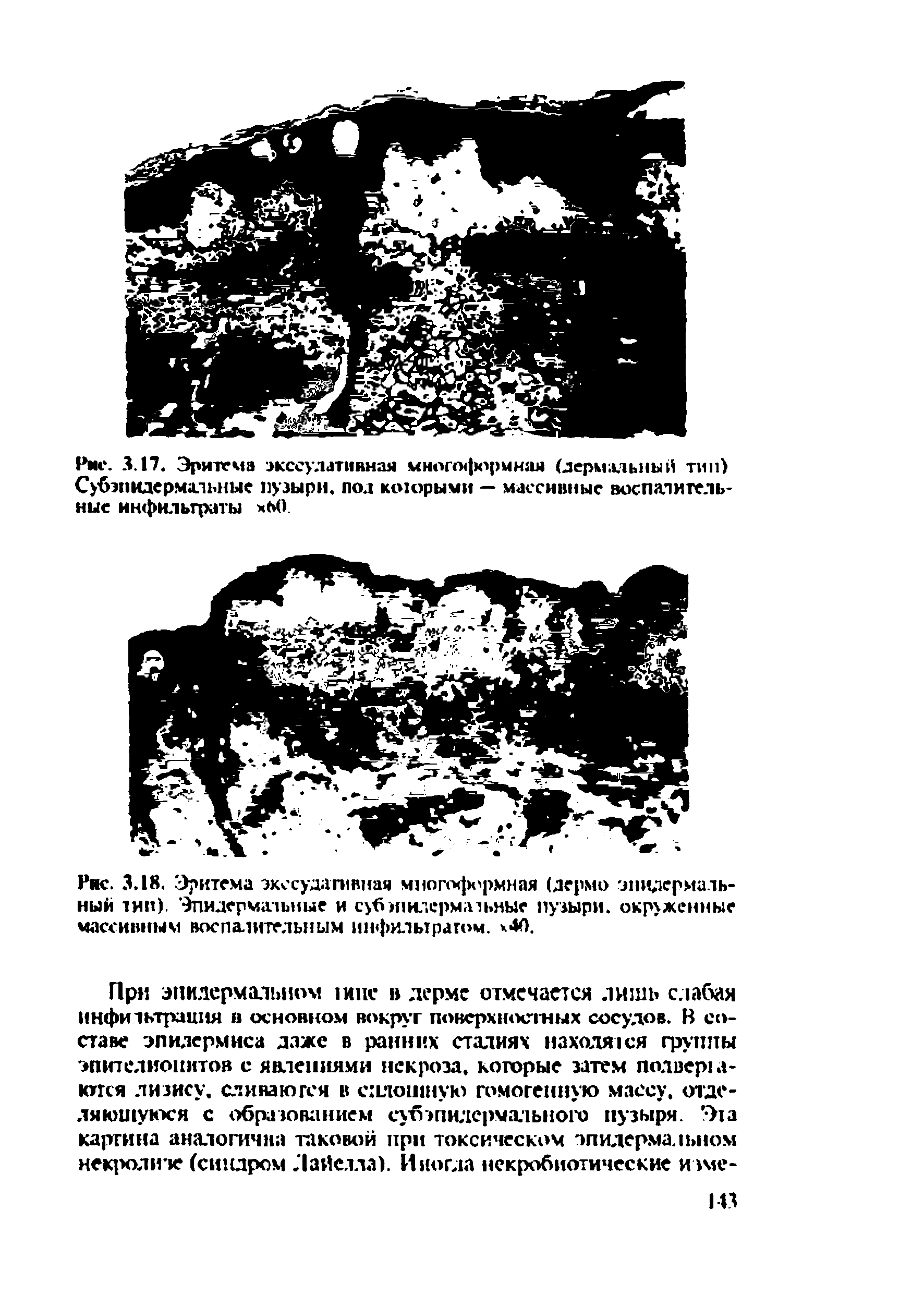 Рис. 3.18. Эритема экссудативная многоформная (дермо -эпидермальный лип). Эпидермальные и суб эпидермальные пузыри, окруженные массивным воспалительным инфилырагом. х40.