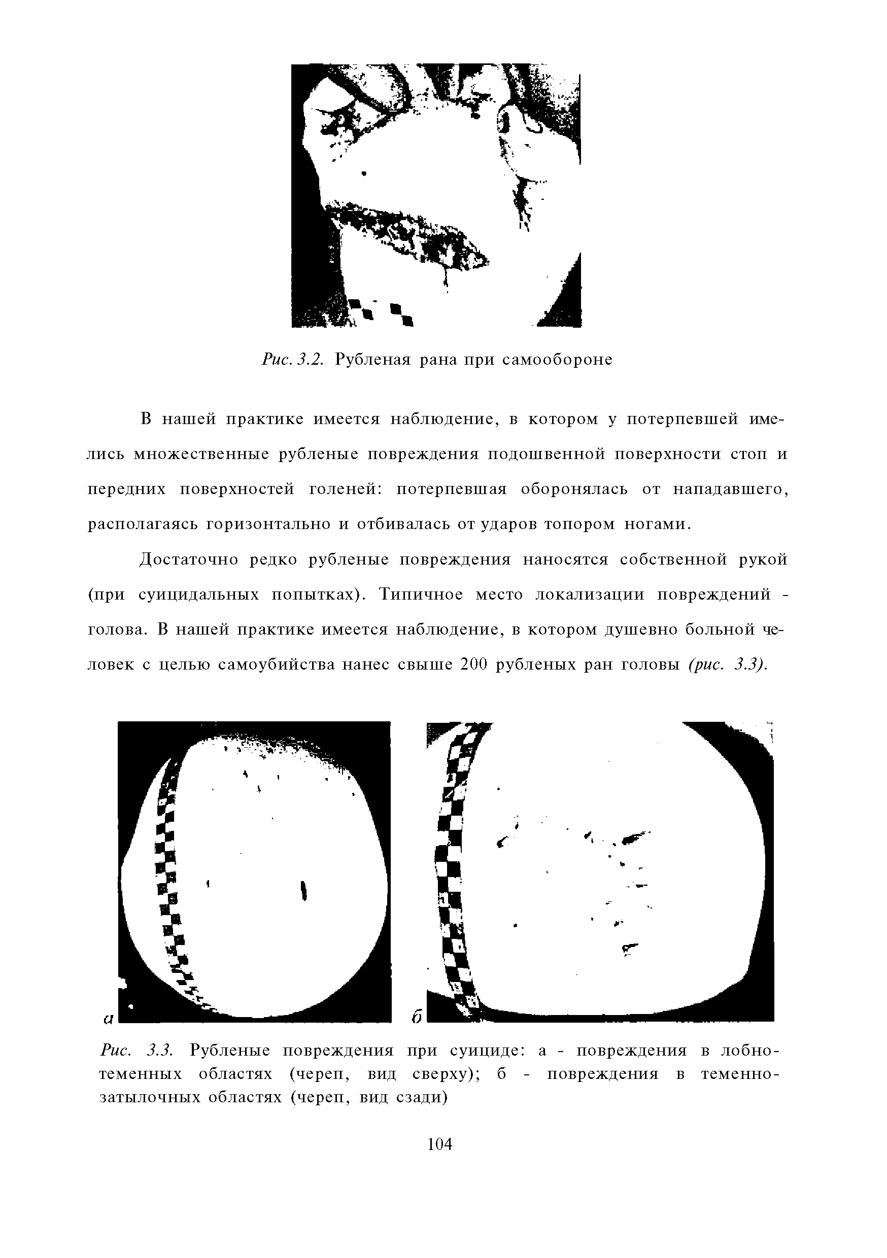 Рис. 3.3. Рубленвге повреждения при суициде а - повреждения в лобнотеменных областях (череп, вид сверху) б - повреждения в теменнозатылочных областях (череп, вид сзади)...