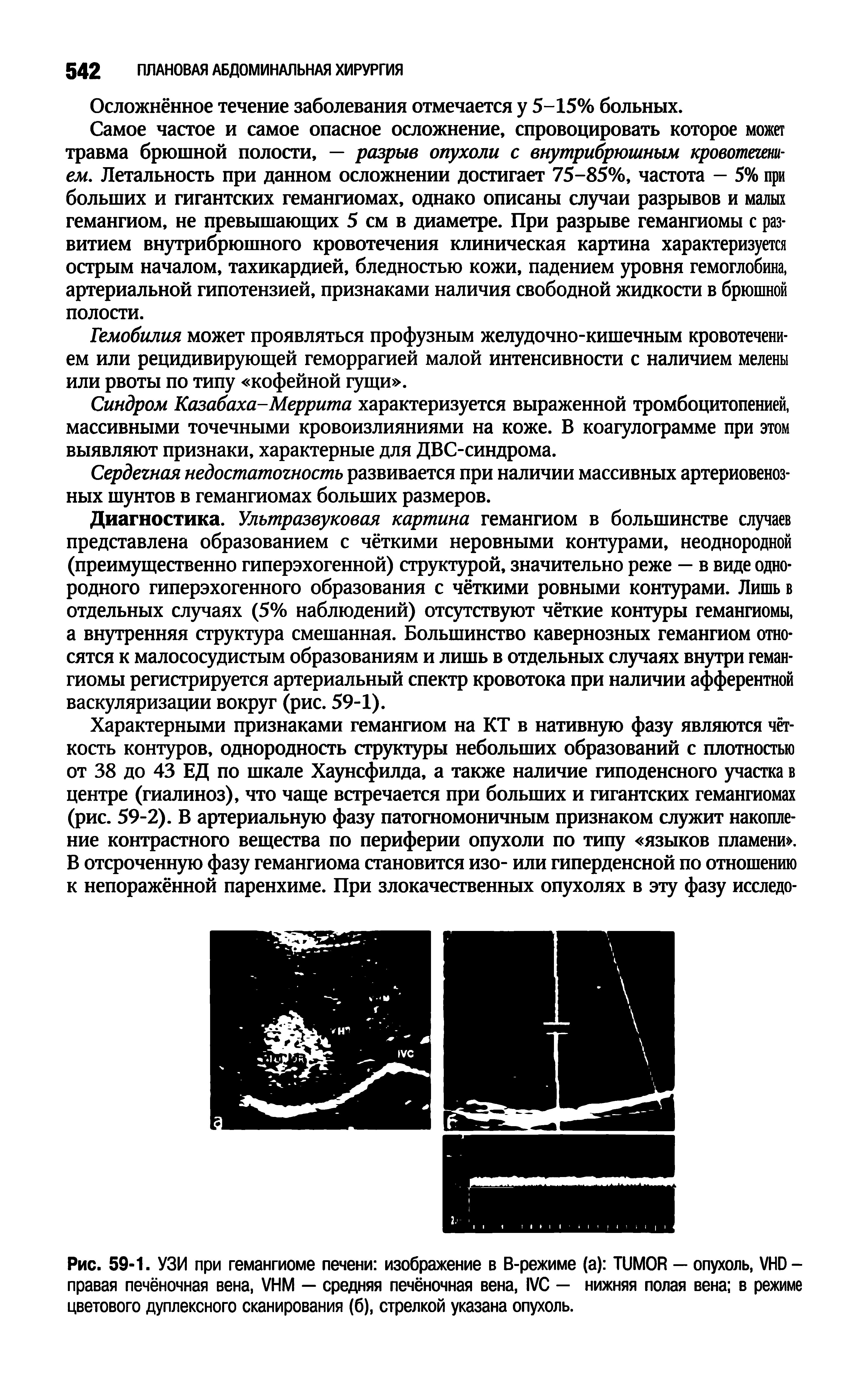 Рис. 59-1. УЗИ при гемангиоме печени изображение в В-режиме ( ) TUMOR — опухоль, VHD-правая печёночная вена, VHM — средняя печёночная вена, IVC — нижняя полая вена в режиме цветового дуплексного сканирования (б), стрелкой указана опухоль.