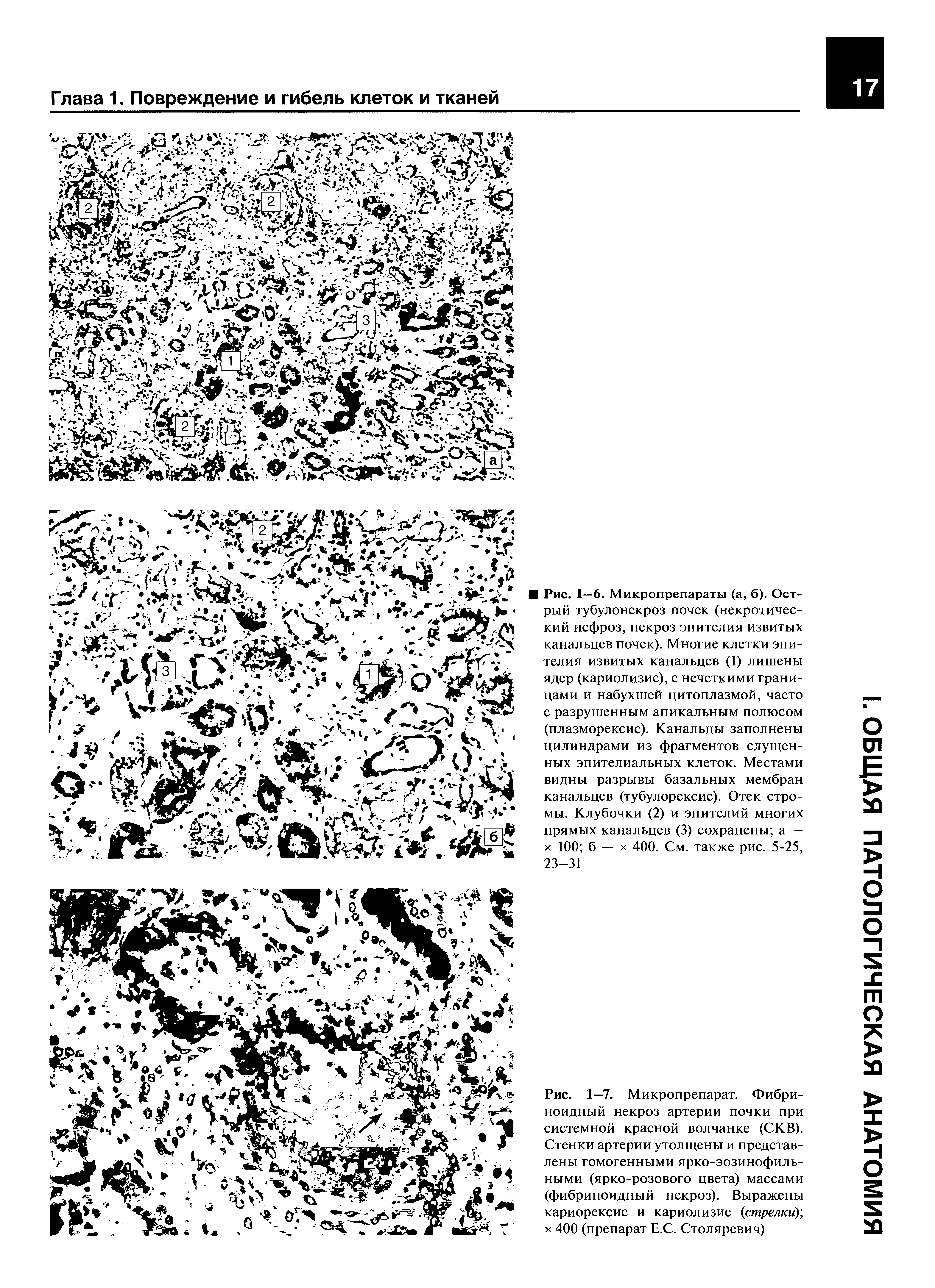 Рис. 1—7. Микропрепарат. Фибриноидный некроз артерии почки при системной красной волчанке (СКВ). Стенки артерии утолщены и представлены гомогенными ярко-эозинофильными (ярко-розового цвета) массами (фибриноидный некроз). Выражены кариорексис и кариолизис стрелки), х 400 (препарат Е.С. Столяревич)...