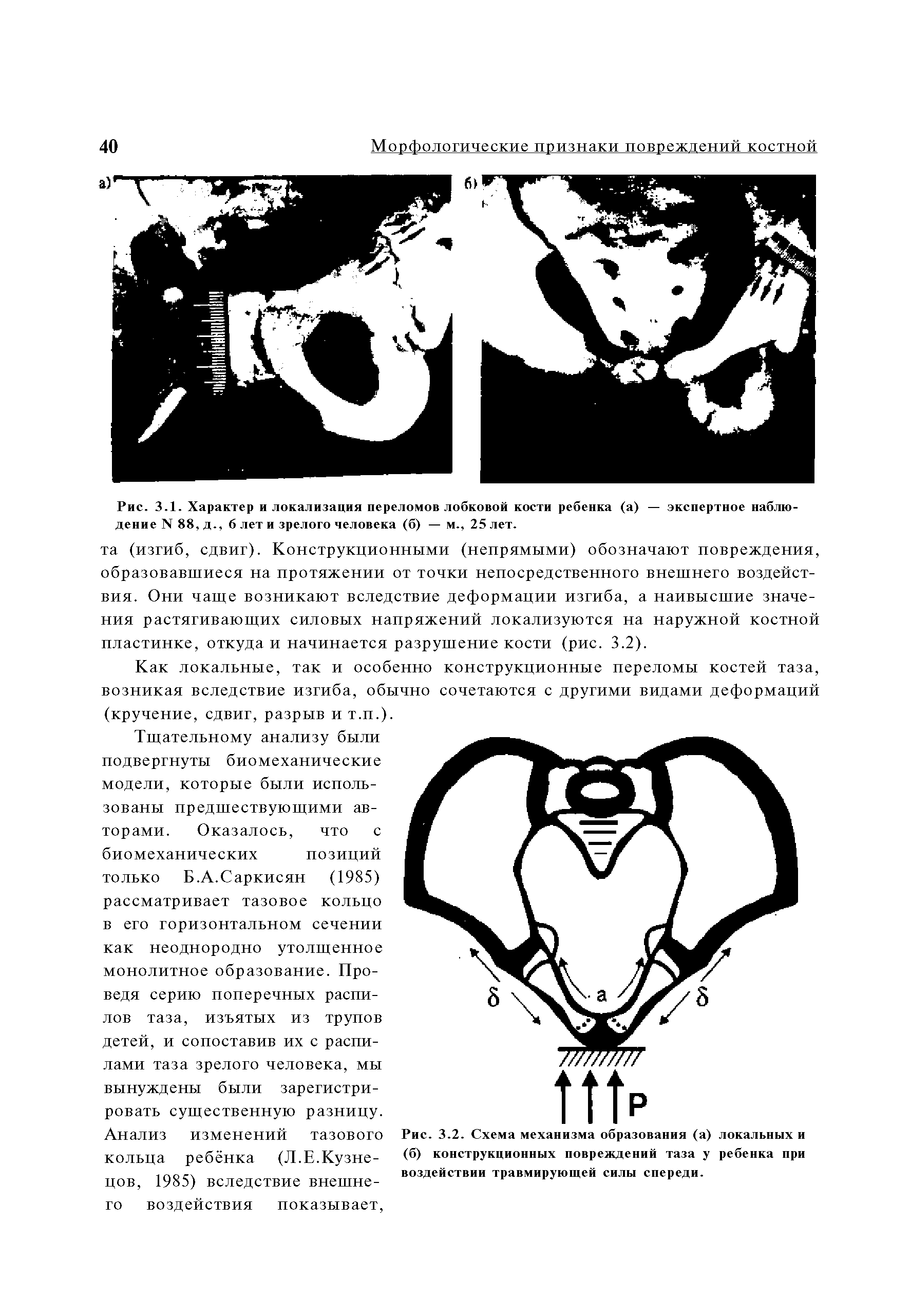 Рис. 3.1. Характер и локализация переломов лобковой кости ребенка (а) — экспертное наблюдение N 88, д., б лет и зрелого человека (б) — м., 25 лет.