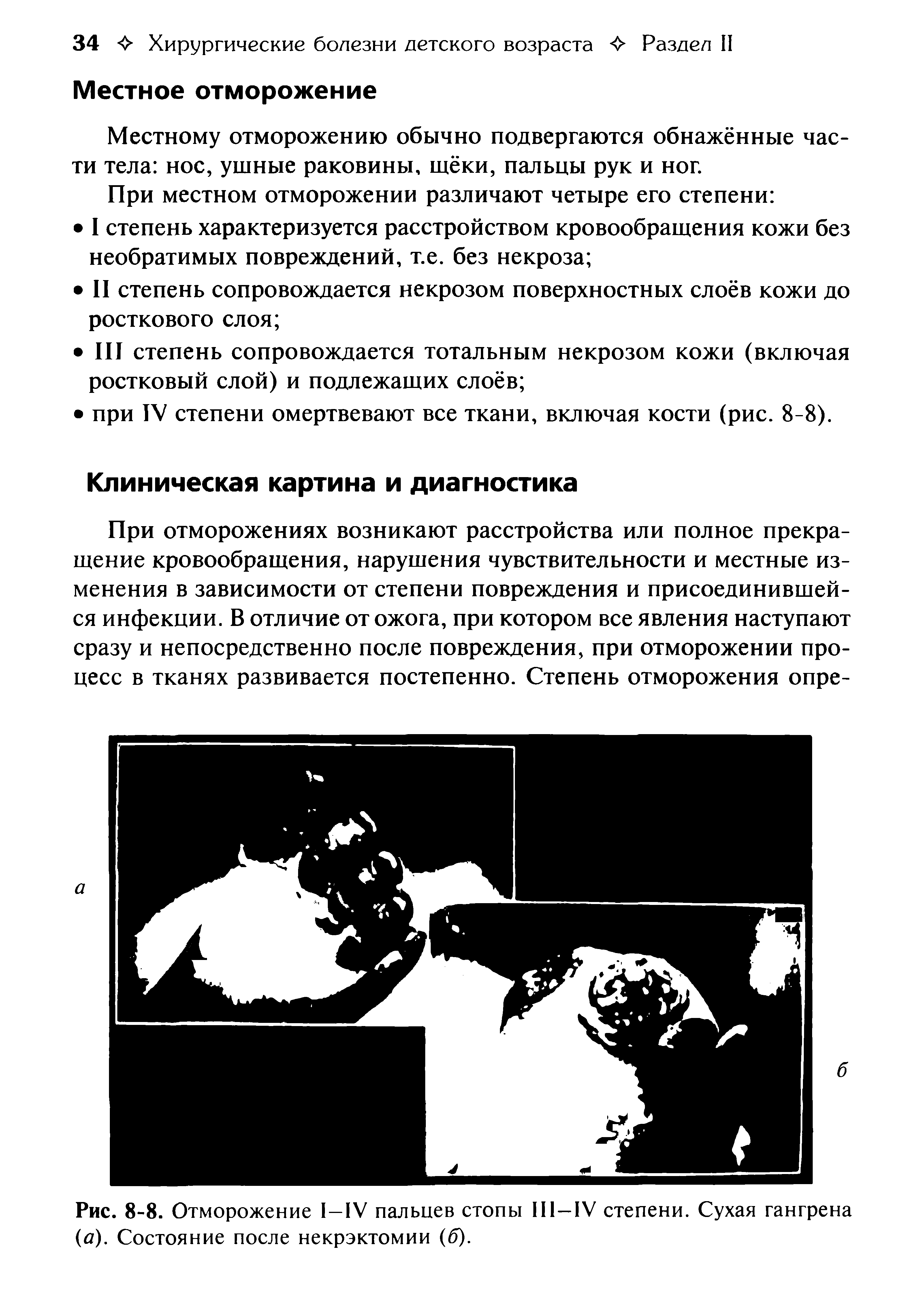 Рис. 8-8. Отморожение 1-1V пальцев стопы 111—IV степени. Сухая гангрена (д). Состояние после некрэктомии (б).