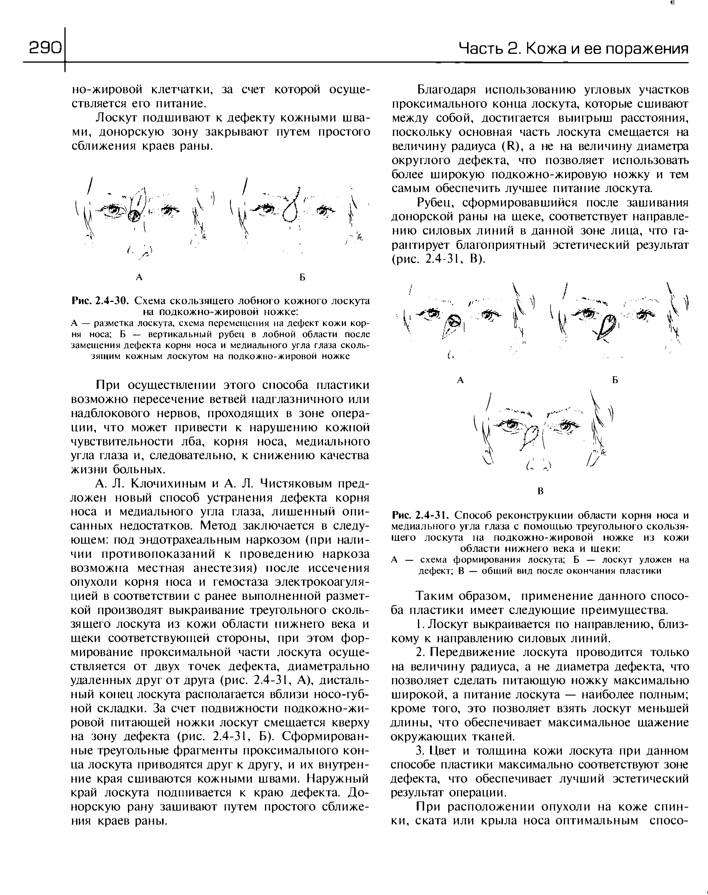 Рис. 2.4-30. Схема скользящего лобного кожного лоскута на подкожно-жировой ножке ...