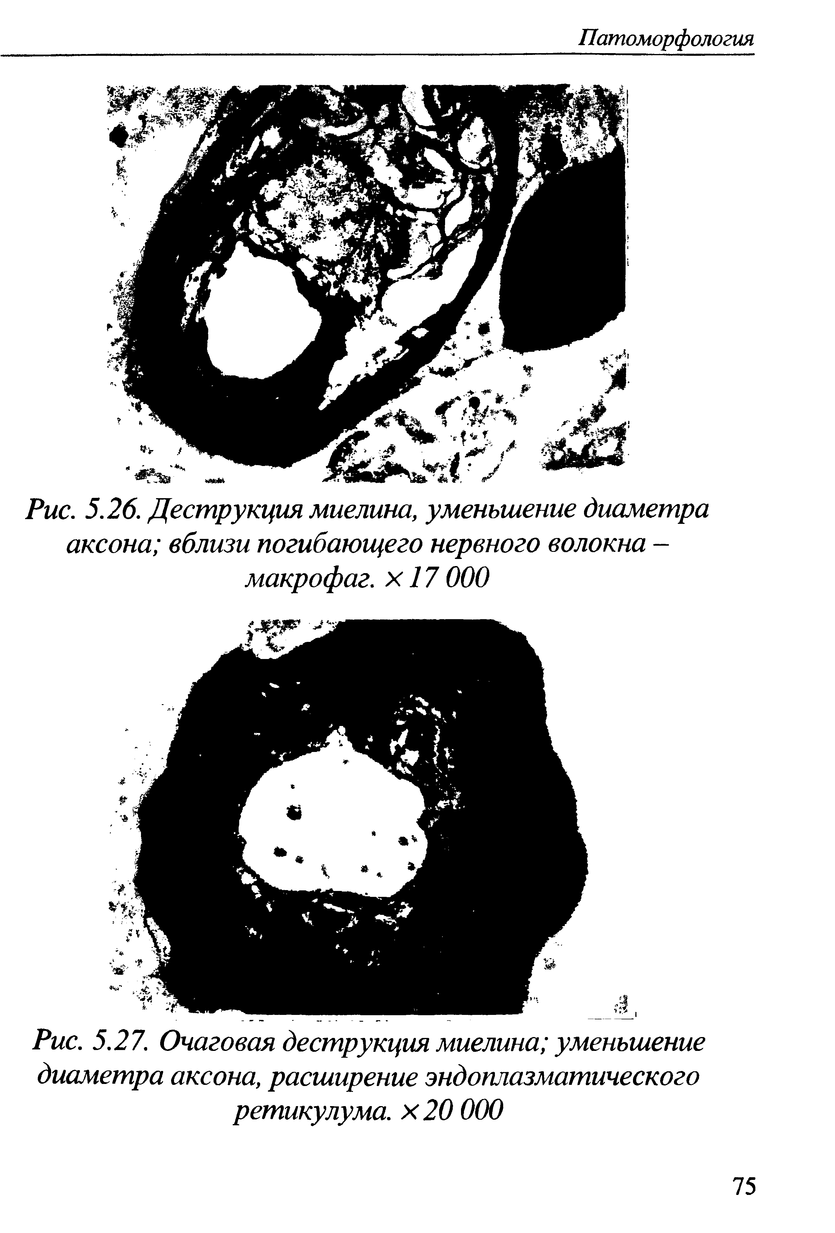 Рис. 5.27. Очаговая деструкция миелина уменьшение диаметра аксона, расширение эндоплазматического ретикулума, х 20 000...