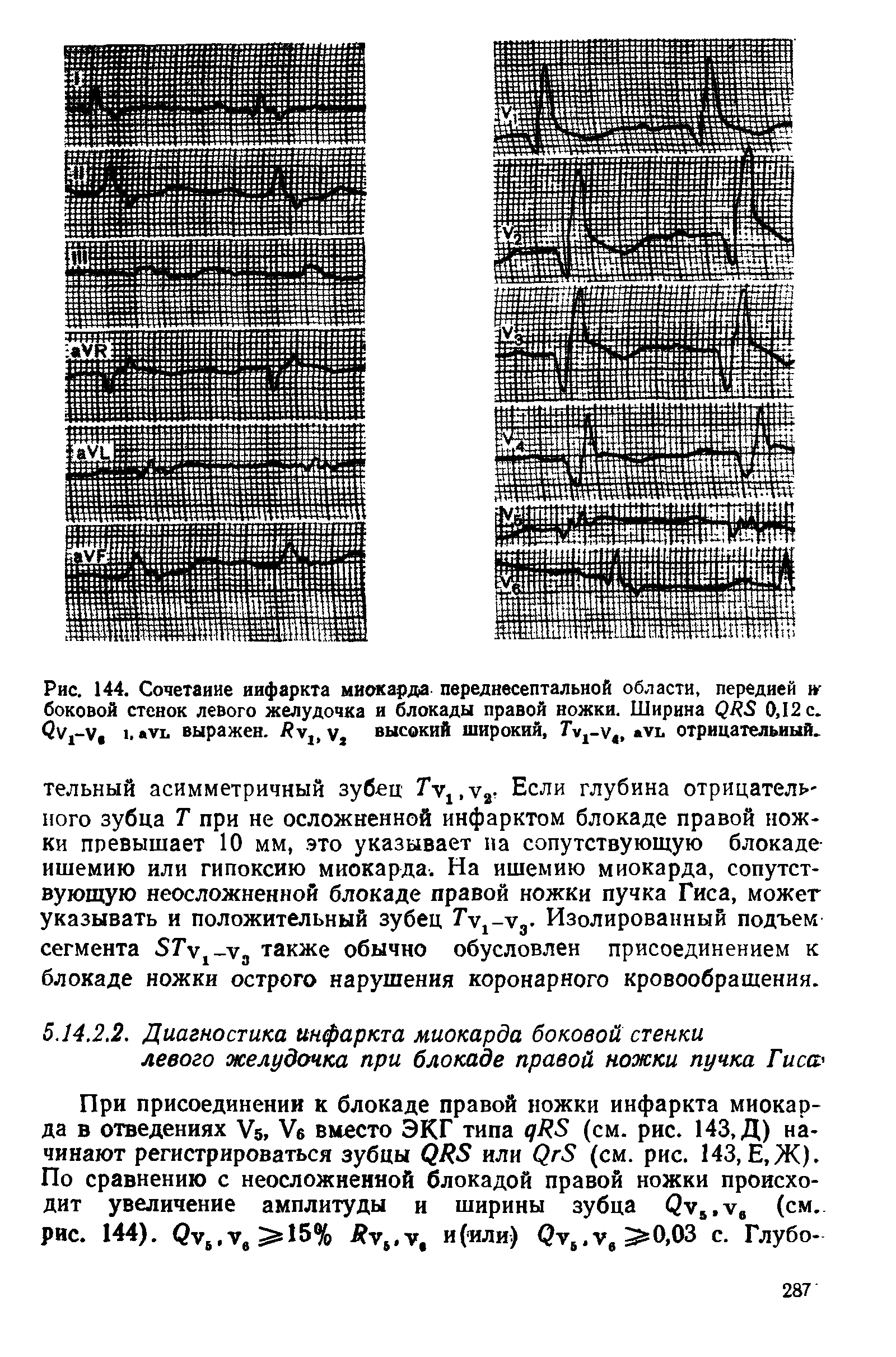 Рис. 144. Сочетание инфаркта миокарда переднесептальной области, передней боковой стенок левого желудочка и блокады правой ножки. Ширина 0,12 с. (2у1-У, >. уь выражен. йу1> у, высокий широкий, ауь отрицательный.