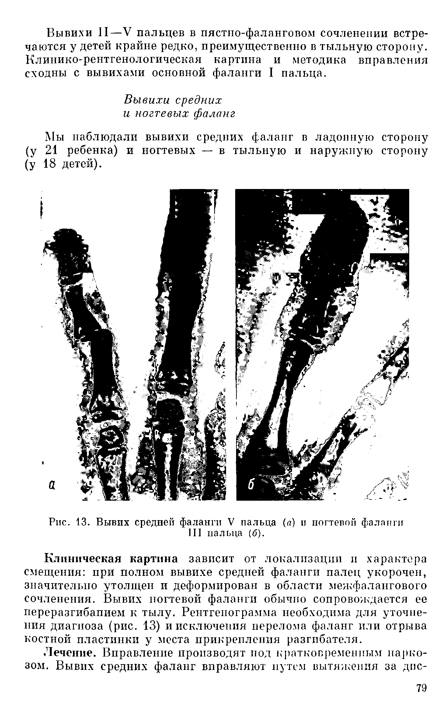 Рис. 13. Вывих средней фаланги V пальца ( ) и ногтевой фаланги III пальца (б).