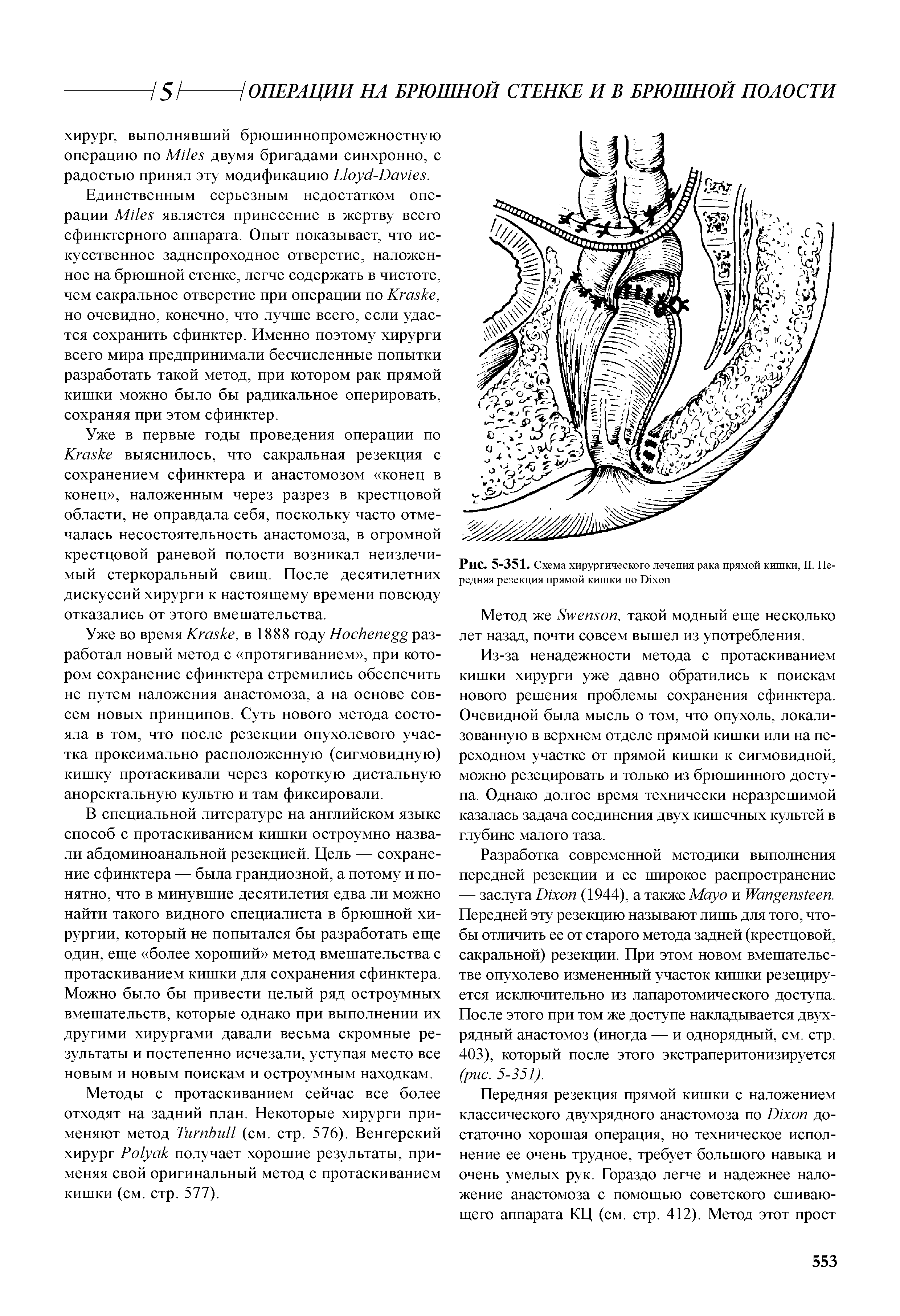 Рис. 5-351. Схема хирургического лечения рака прямой кишки, II. Передняя резекция прямой кишки по D ...