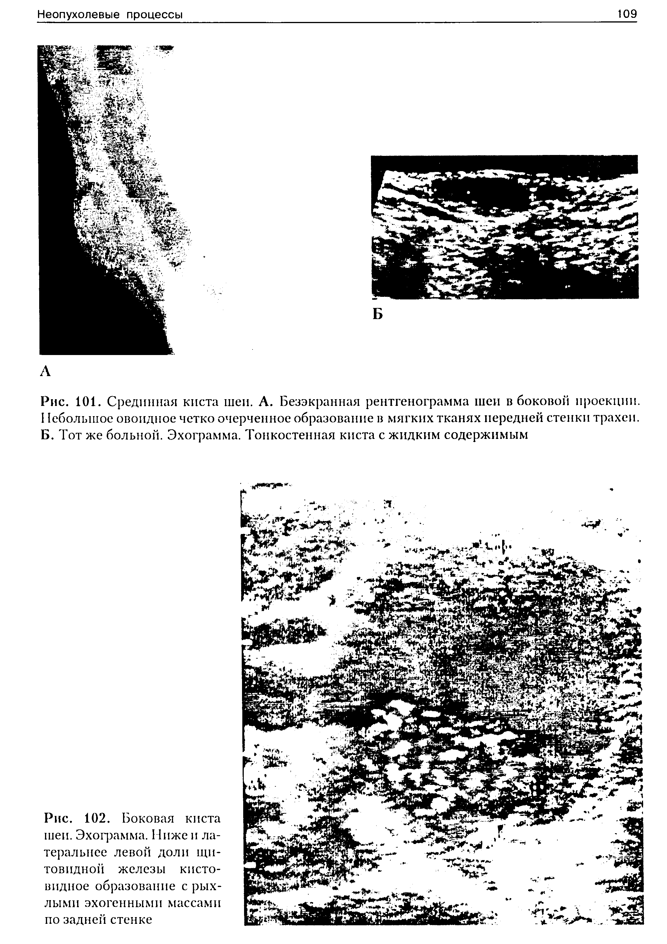 Рис. 101. Срединная киста шеи. А. Безэкранная рентгенограмма шеи в боковой проекции. 11еболыпое овоидное четко очерченное образование в мягких тканях передней стенки трахеи. Б. Тот же больной. Эхограмма. Тонкостенная киста с жидким содержимым...