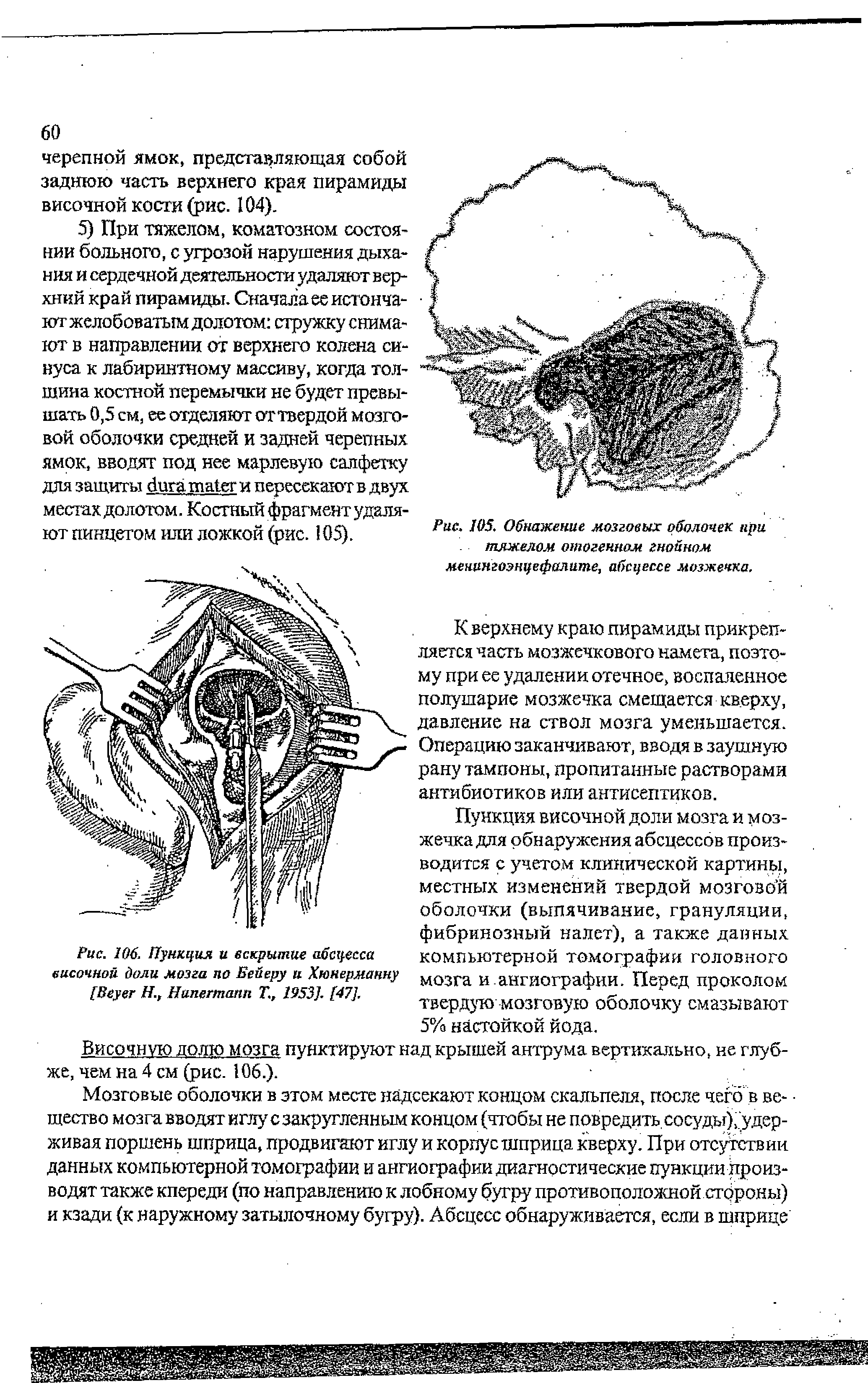 Рис. 105. Обнажение мозговых оболочек при тяжелом отогенном гнойном менингоэнцефалите, абсцессе мозжечка.