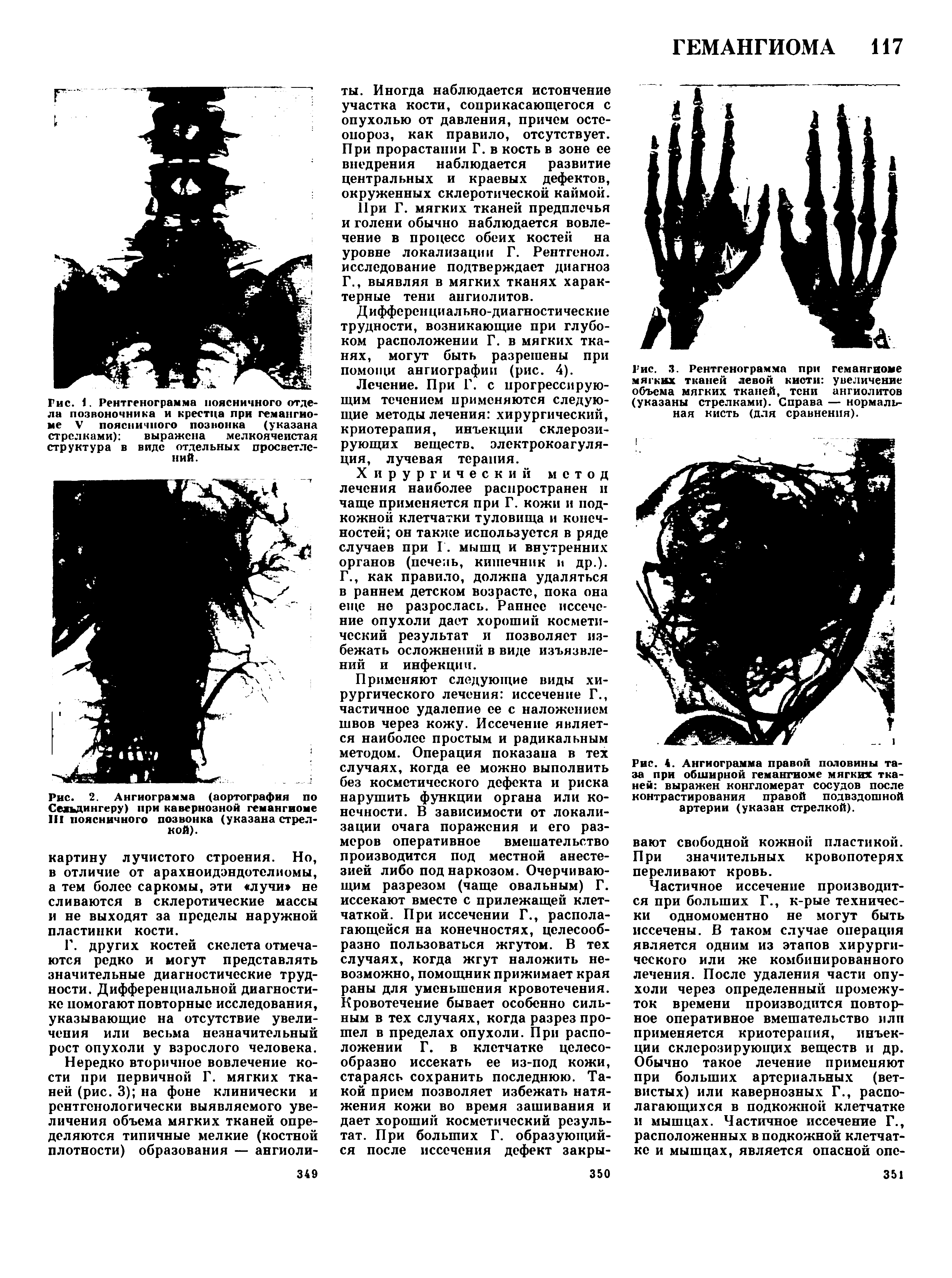 Рис. 2. Ангиограмма (аортография по Сеяъдингеру) при кавернозной гемангиоме III поясничного позвонка (указана стрелкой).