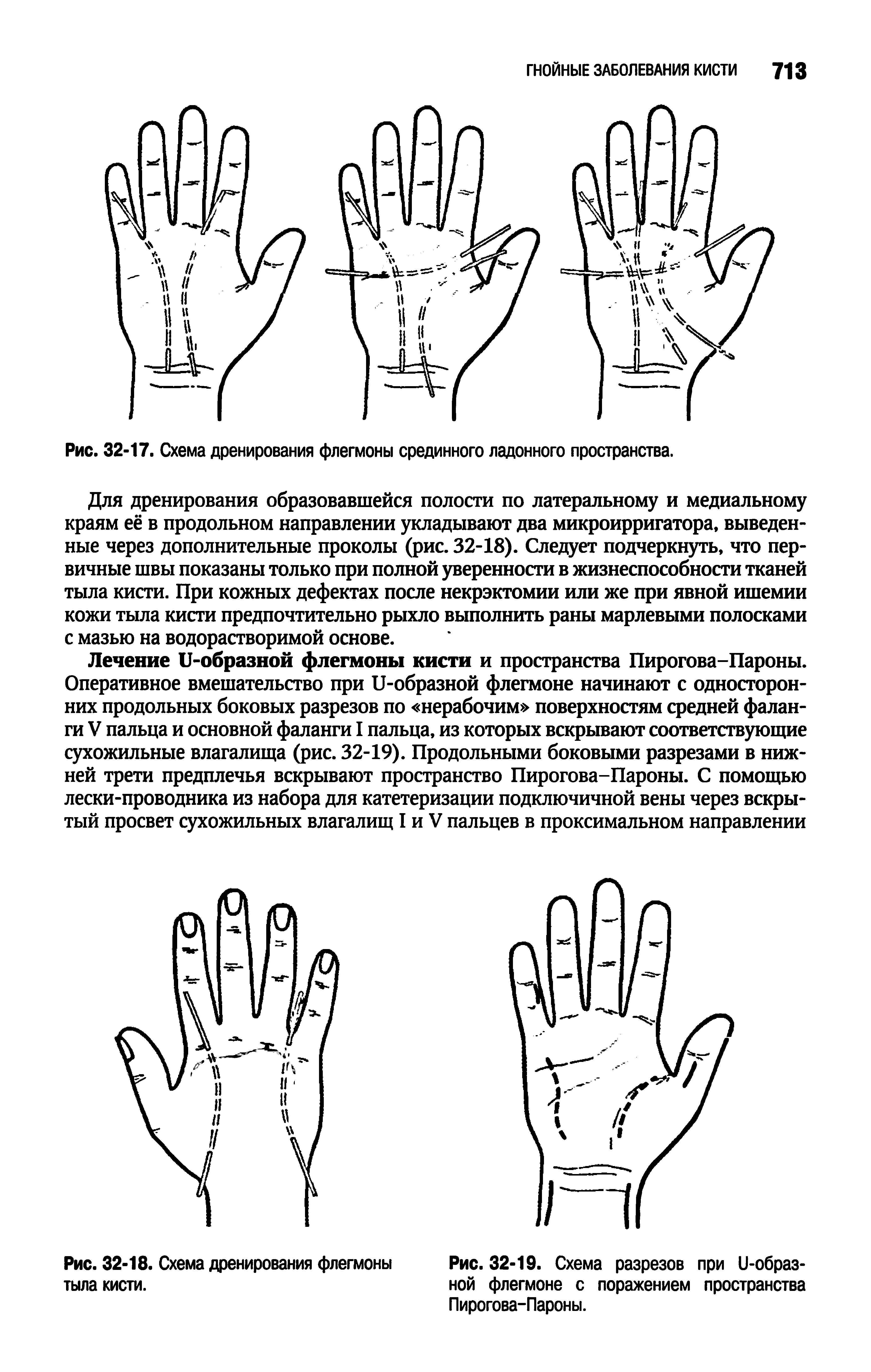 Рис. 32-19. Схема разрезов при и-образ-ной флегмоне с поражением пространства Пирогова-Пароны.