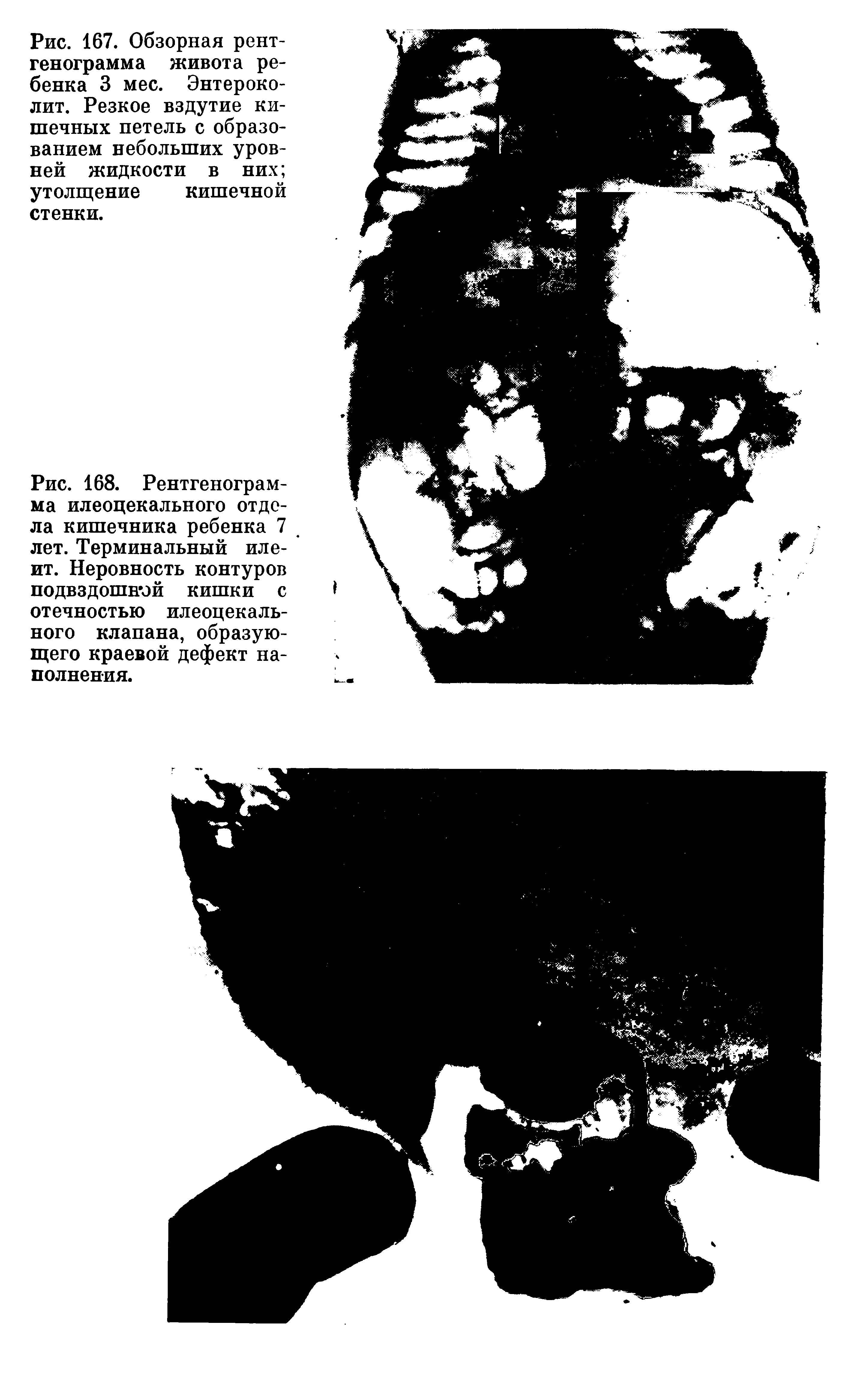 Рис. 168. Рентгенограмма илеоцекального отдела кишечника ребенка 7 лет. Терминальный илеит. Неровность контуров подвздошной кишки с отечностью илеоцекального клапана, образующего краевой дефект наполнения.