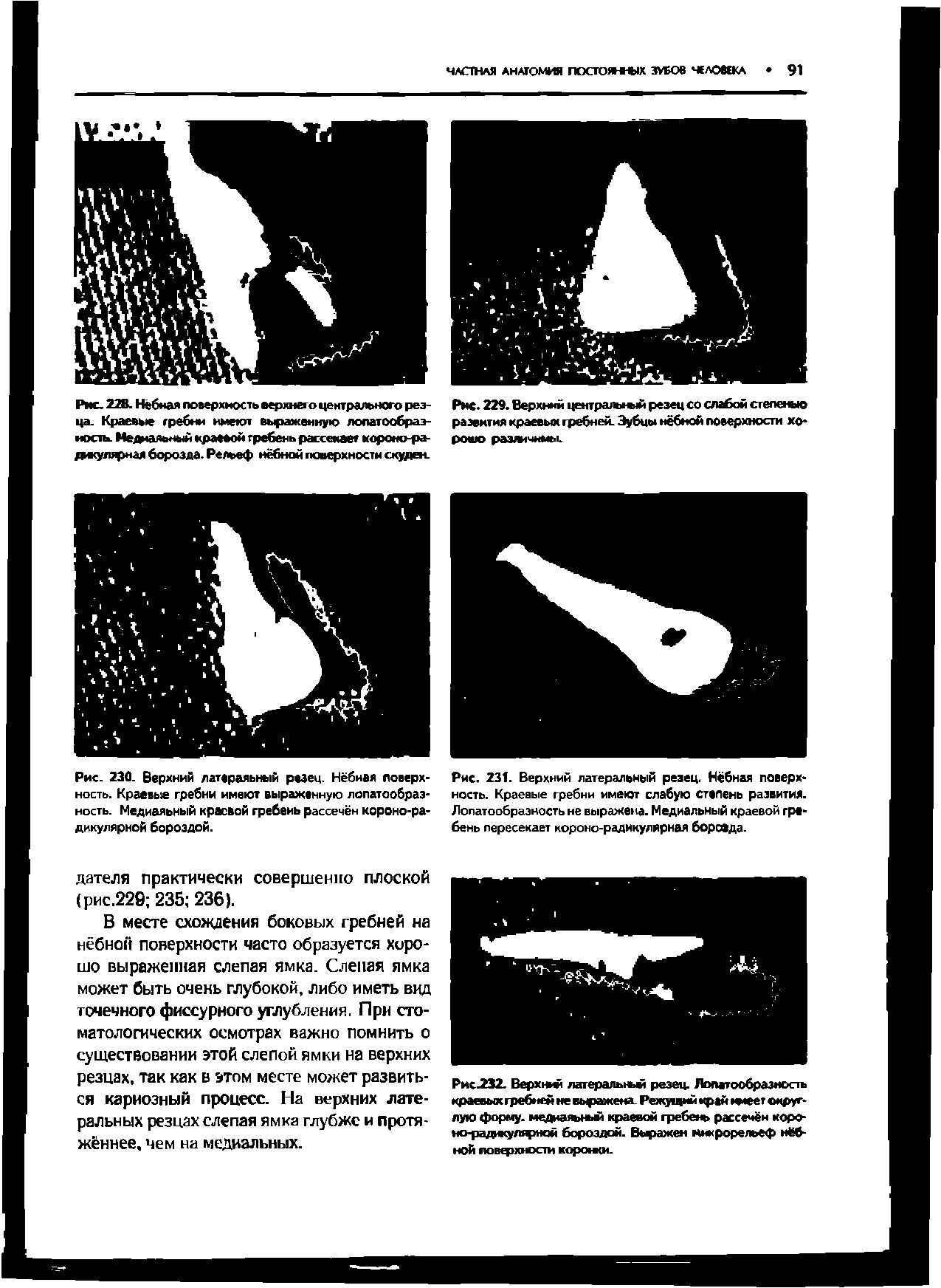 Рис.232. Верхньш лагеральньш резец. Лопатообраэность краевых гребней не выражена Режущий край ьюег округлую форму, медиагъньы краевой гребень рассечён коро-но-радодглгфной бороздой. Вьфажен микрорельеф нёбной повфхности коронен.