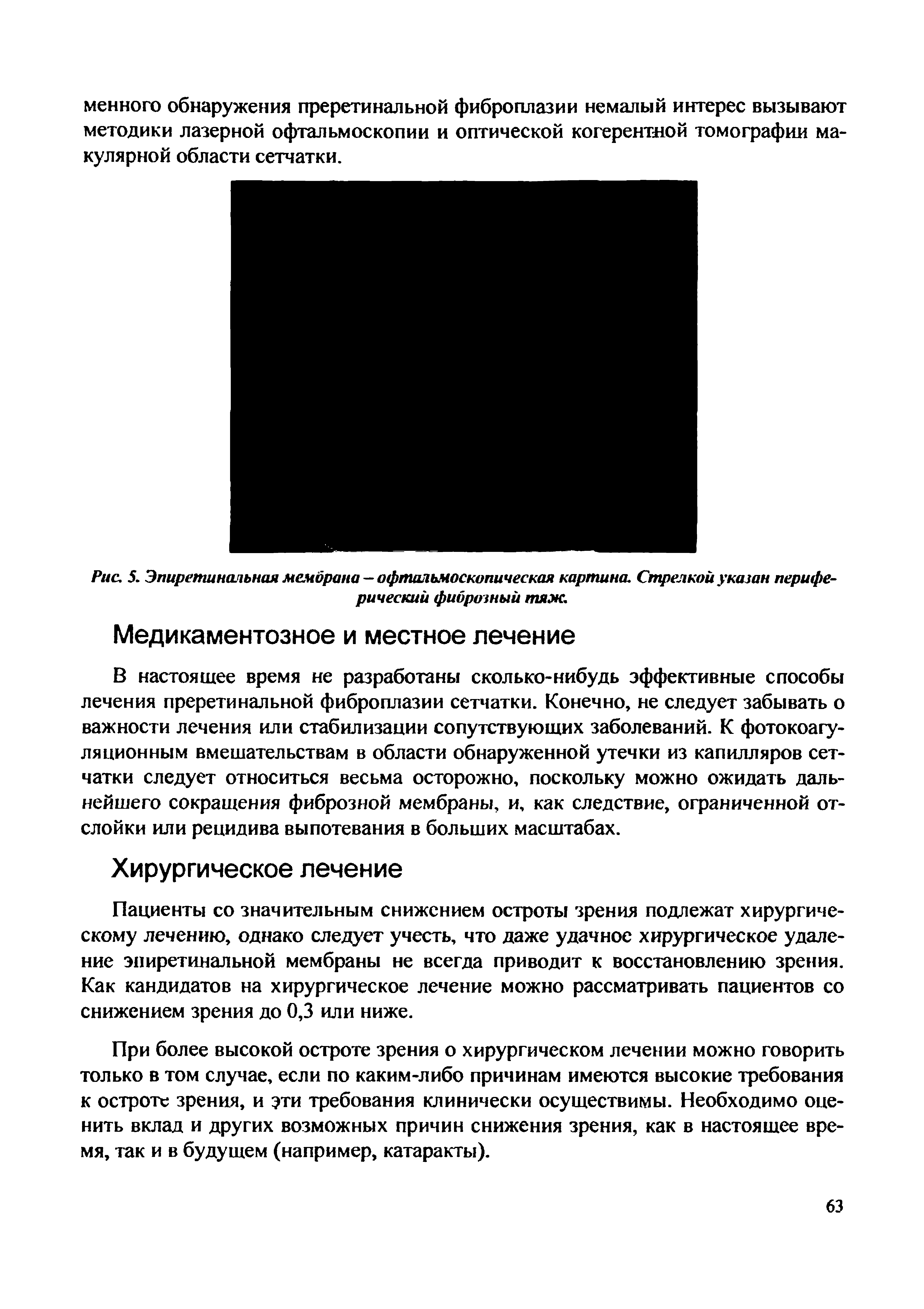 Рис. 5. Эпиретинальная мембрана — офтальмоскопическая картина. Стрелкой указан периферический фиброзный тяж.