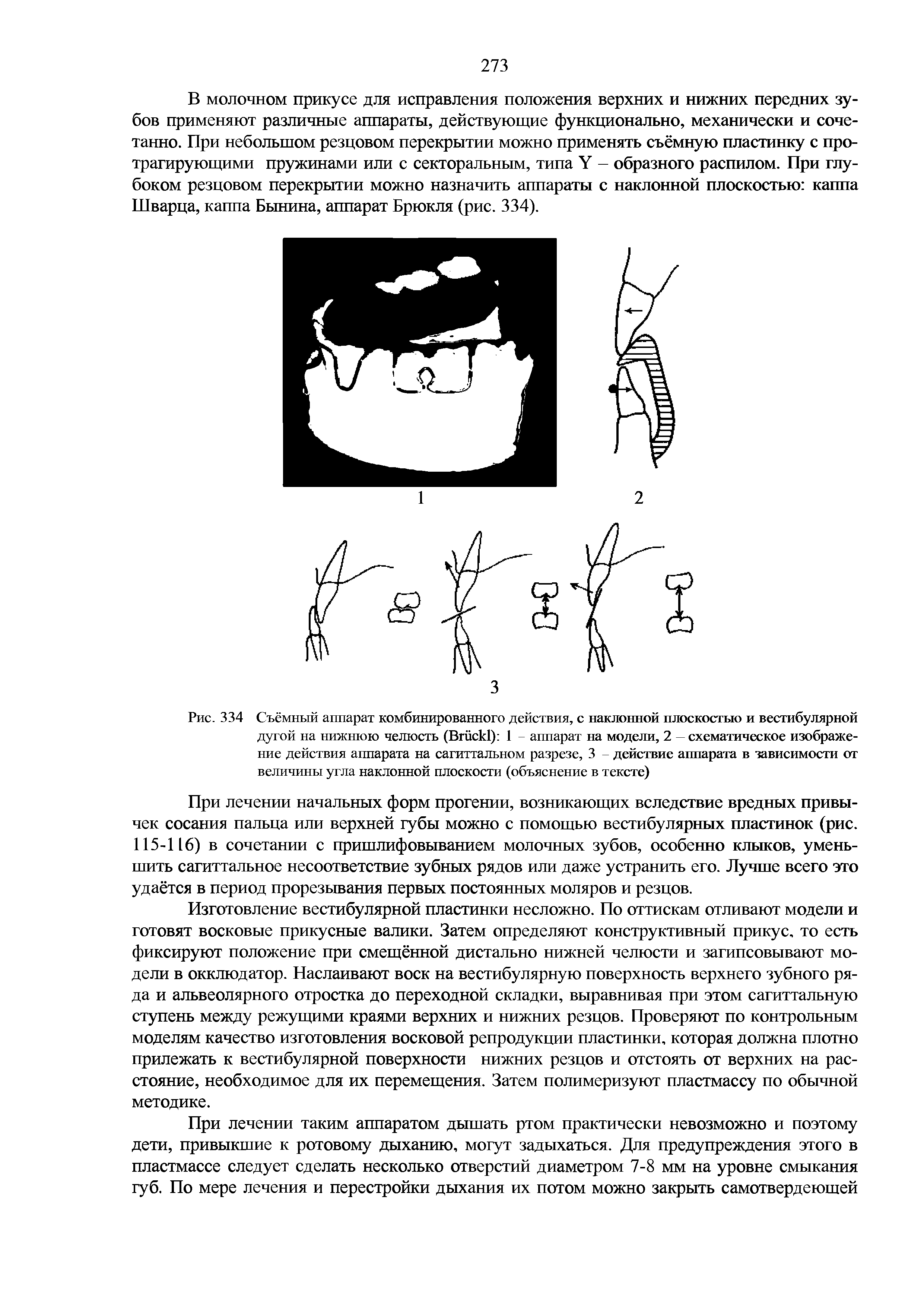 Рис. 334 Съёмный аппарат комбинированного действия, с наклонной плоскостью и вестибулярной дугой на нижнюю челюсть (B ) 1 - аппарат на модели, 2 — схематическое изображение действия аппарата на сагиттальном разрезе, 3 - действие аппарата в зависимости от величины угла наклонной плоскости (объяснение в тексте)...