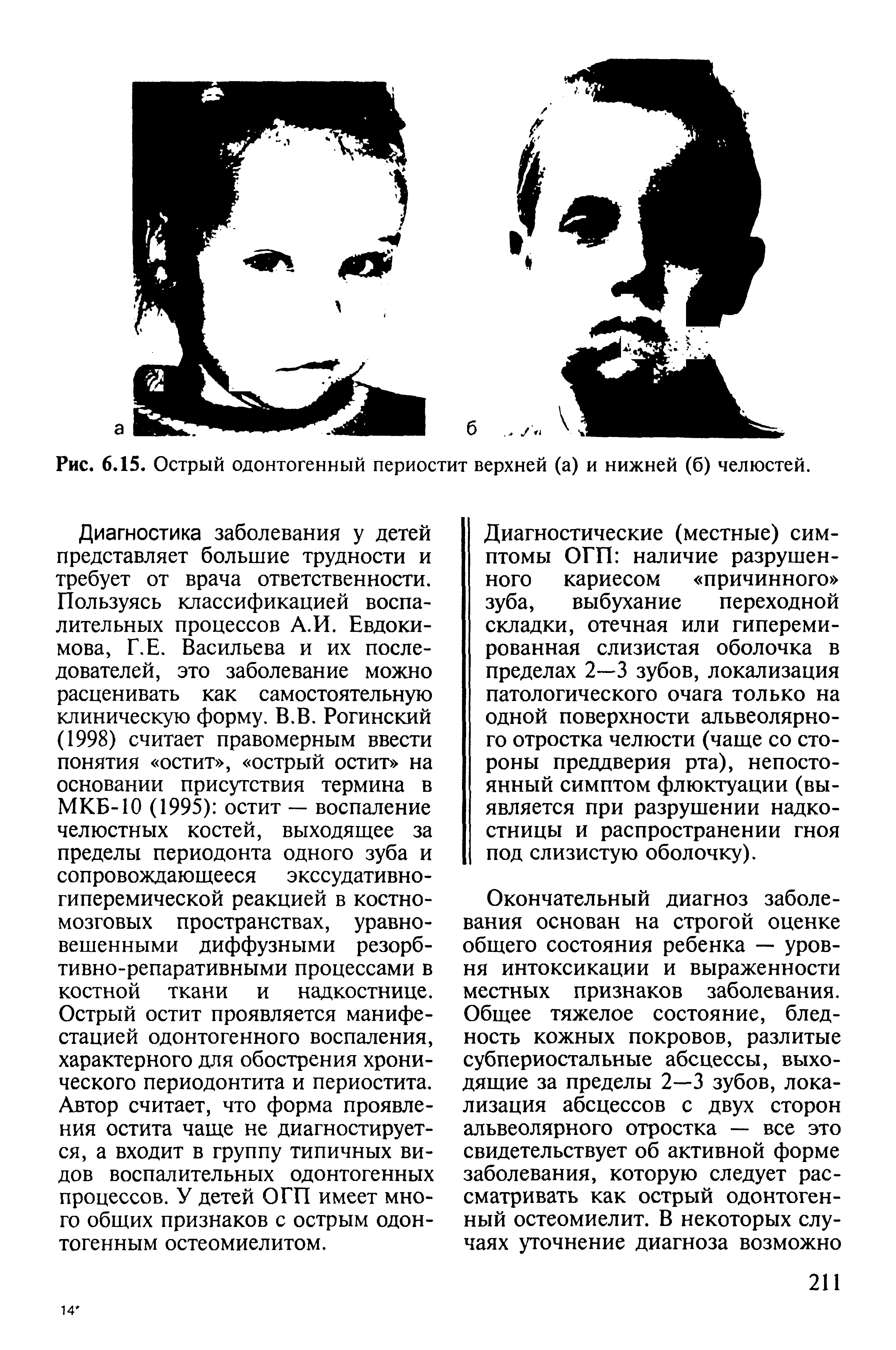 Рис. 6.15. Острый одонтогенный периостит верхней (а) и нижней (б) челюстей.