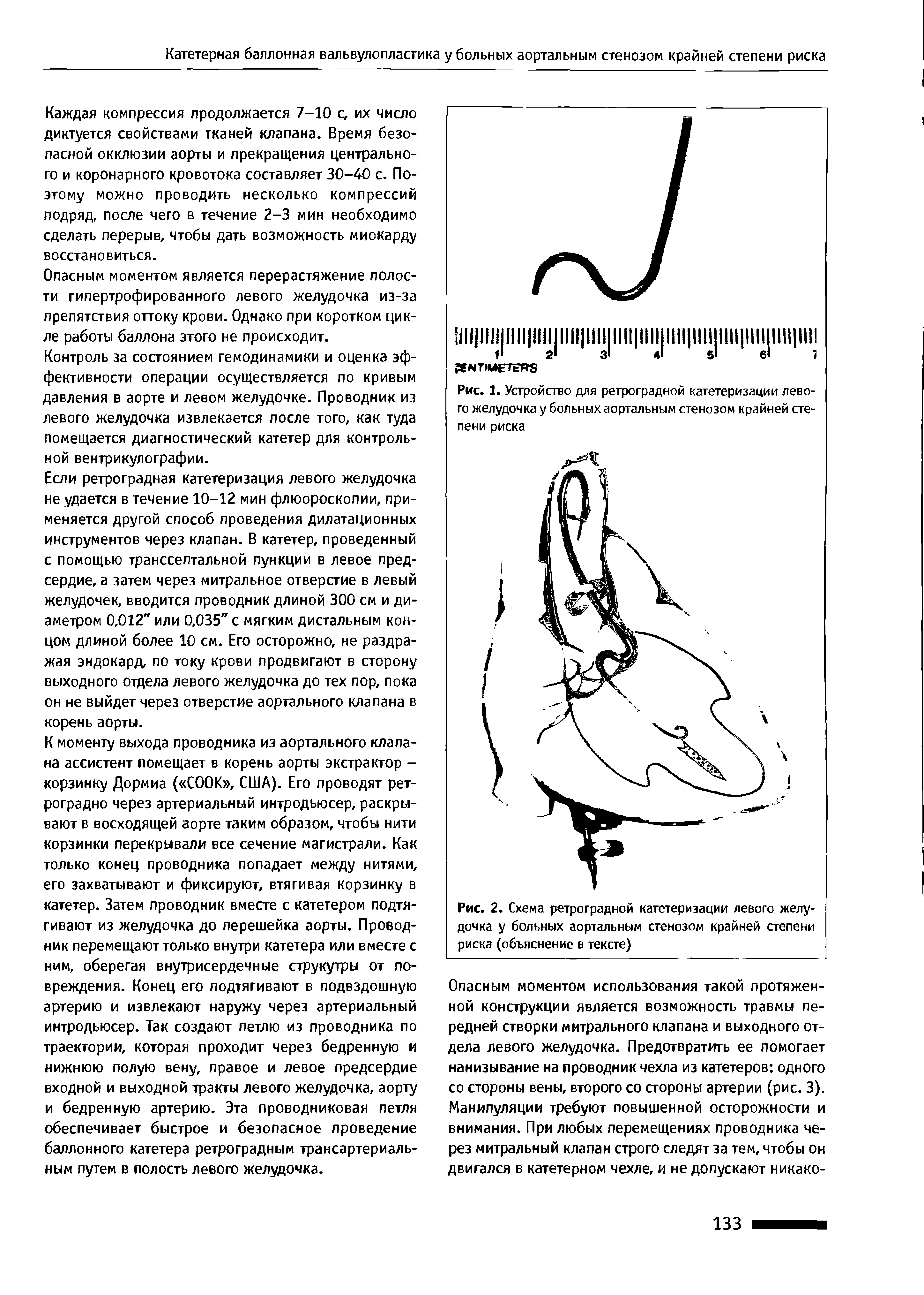 Рис. 1. Устройство для ретроградной катетеризации левого желудочка у больных аортальным стенозом крайней степени риска...