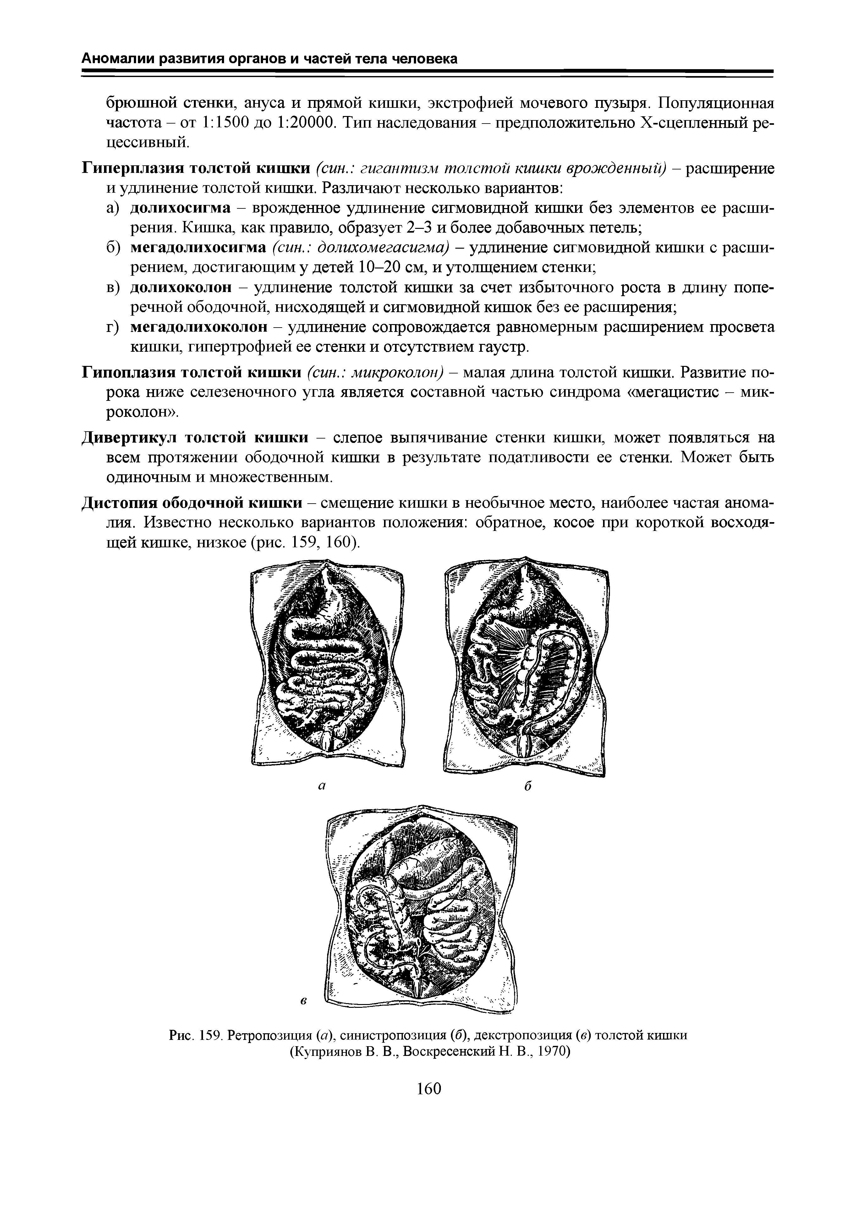 Рис. 159. Ретропозиция (а), синистропозиция (б), декстропозиция (в) толстой кишки (Куприянов В. В., Воскресенский Н. В., 1970)...