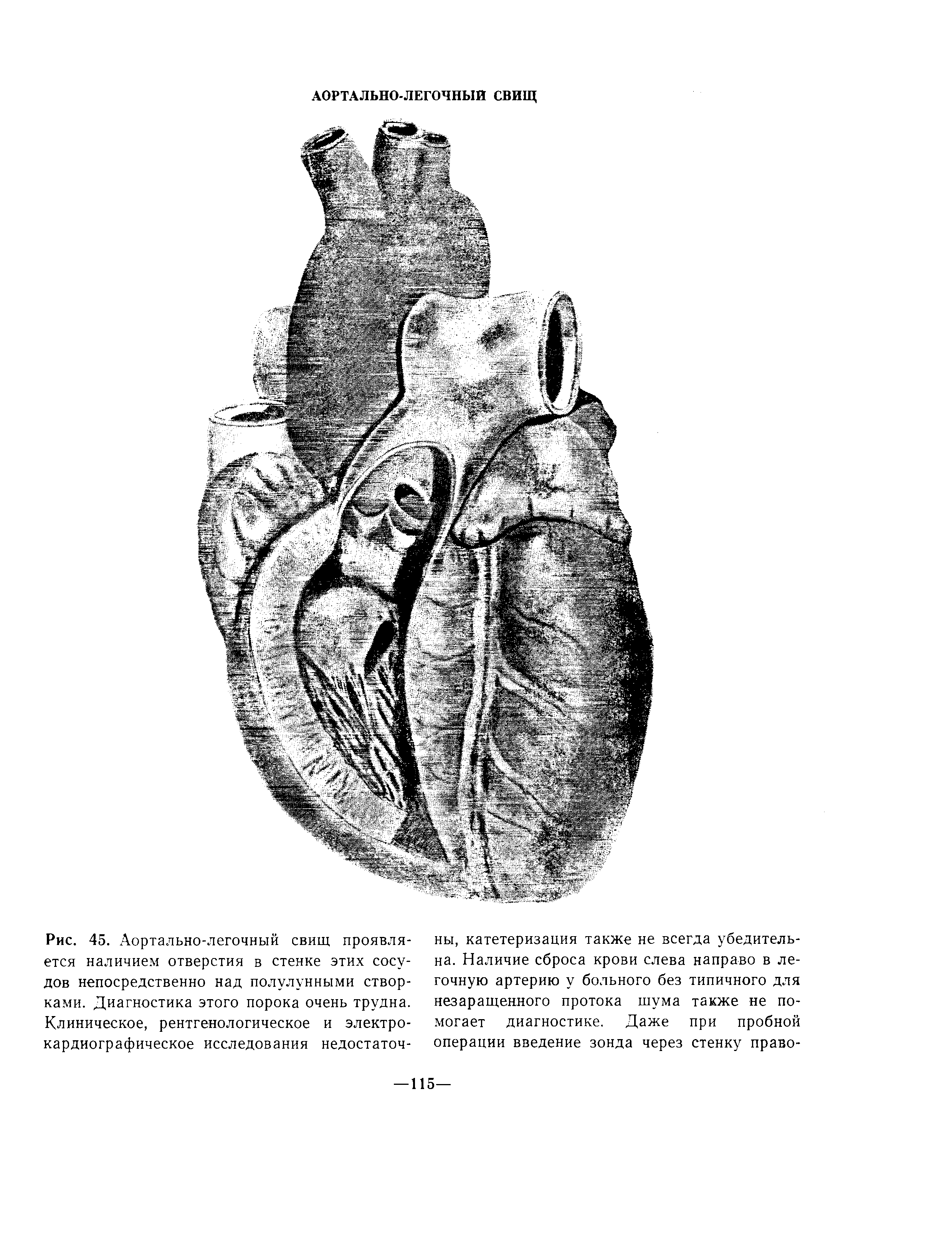 Рис. 45. Аортально-легочный свищ проявляется наличием отверстия в стенке этих сосудов непосредственно над полулунными створками. Диагностика этого порока очень трудна. Клиническое, рентгенологическое и электрокардиографическое исследования недостаточ...