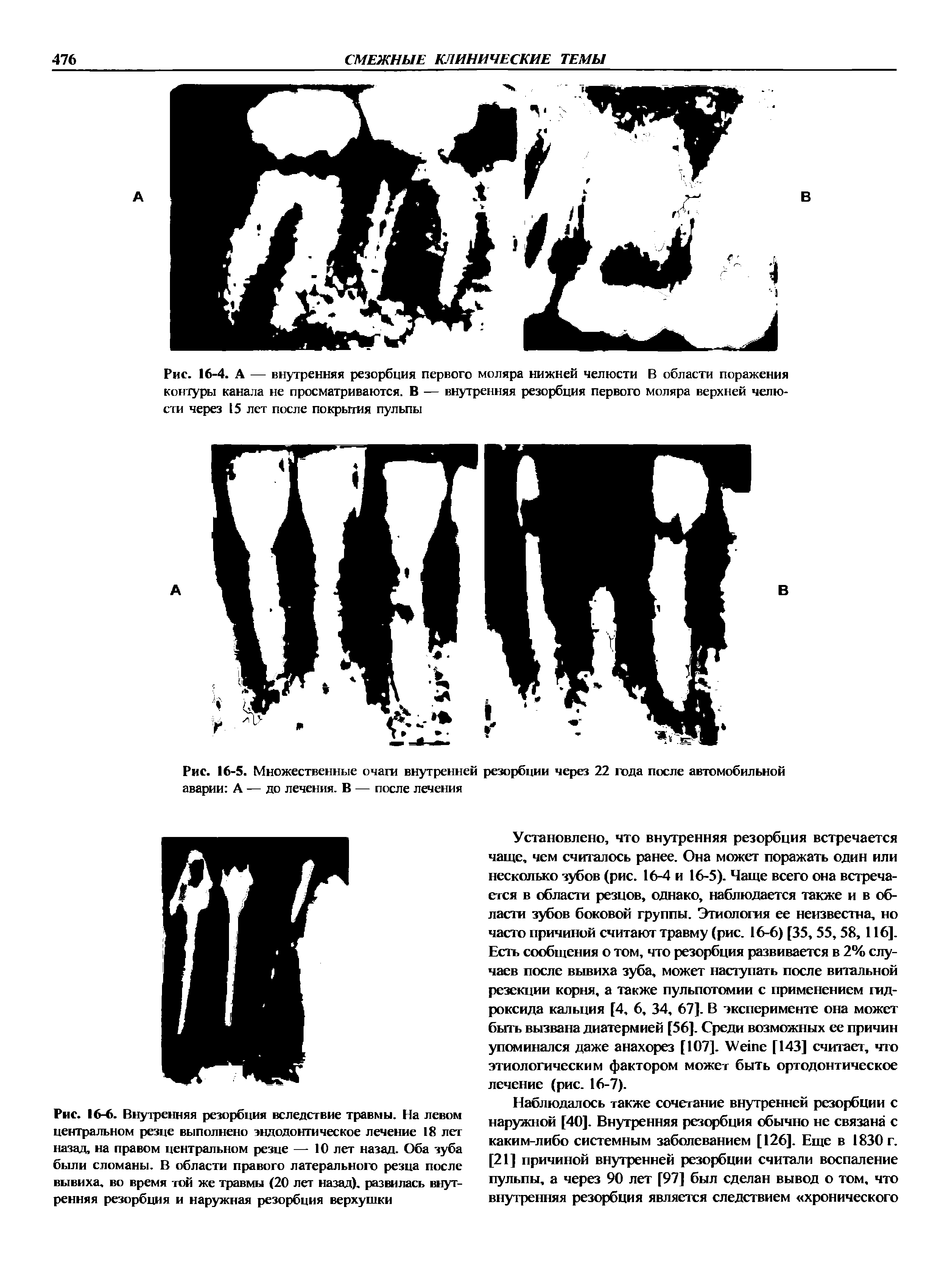Рис. 16-5. Множественные очаги внутренней резорбции через 22 года после автомобильной аварии А — до лечения. В — после лечения...