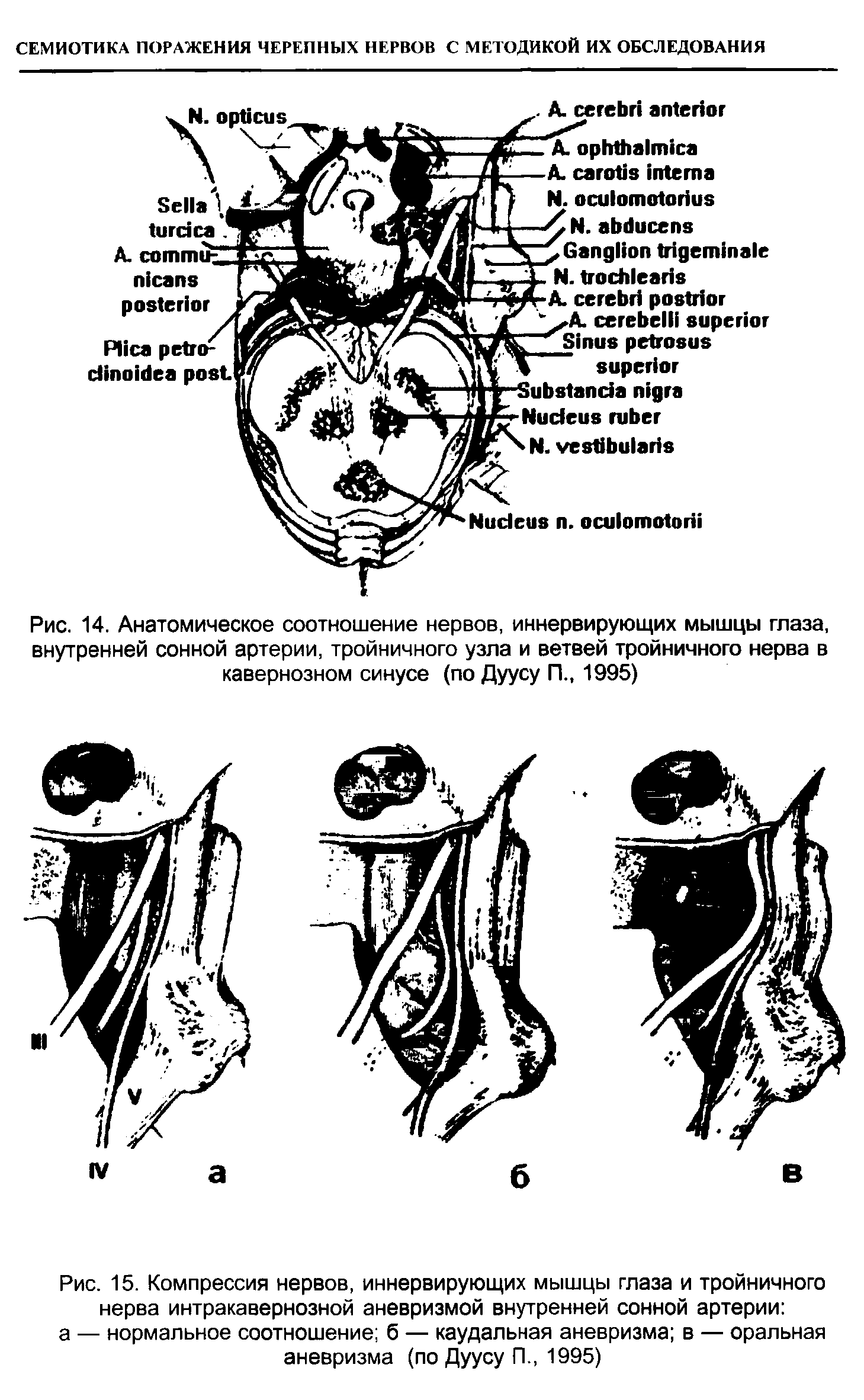 Рис. 14. Анатомическое соотношение нервов, иннервирующих мышцы глаза, внутренней сонной артерии, тройничного узла и ветвей тройничного нерва в кавернозном синусе (по Дуусу П., 1995)...