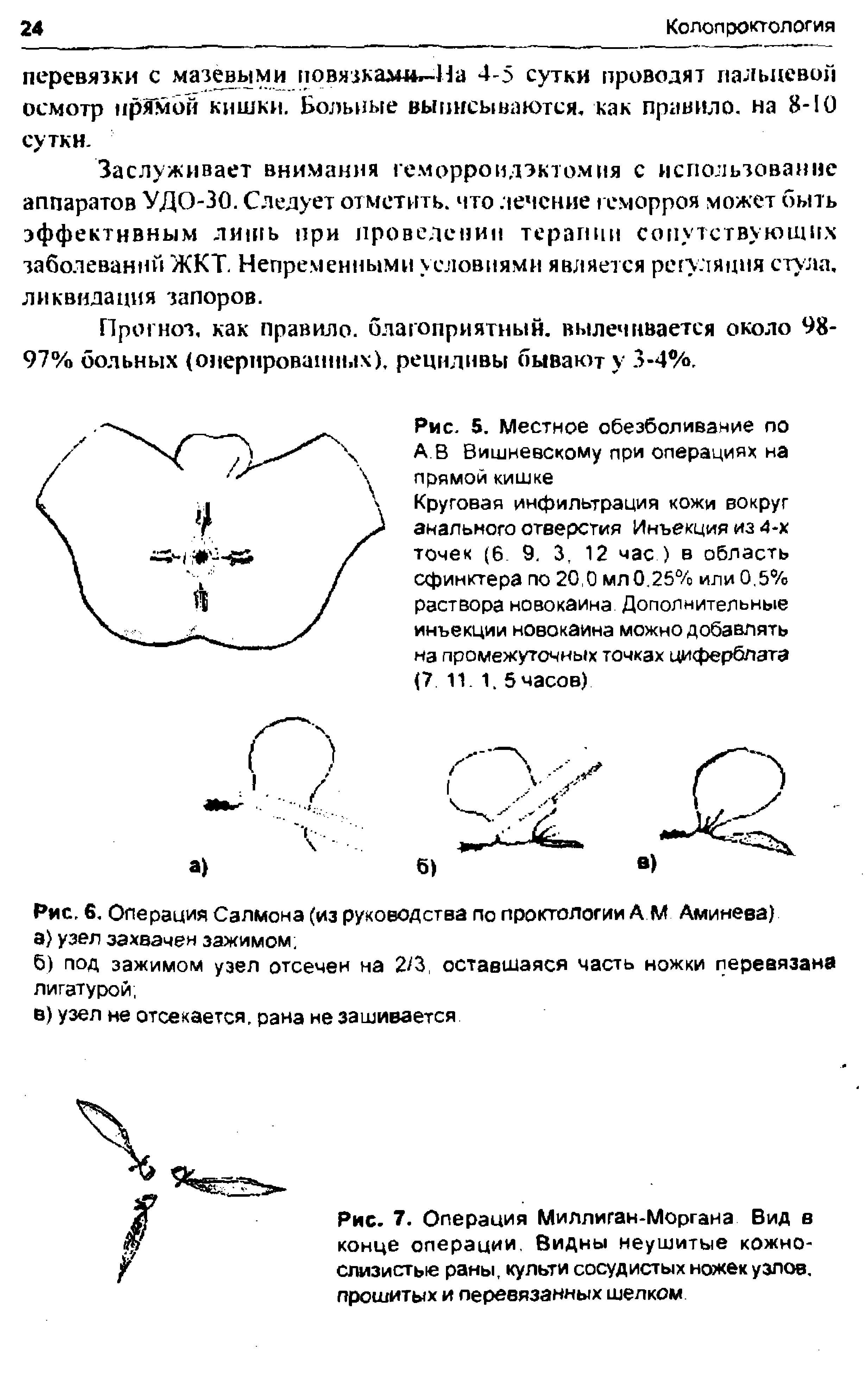 Рис. 5. Местное обезболивание по А.В Вишневскому при операциях на прямой кишке...