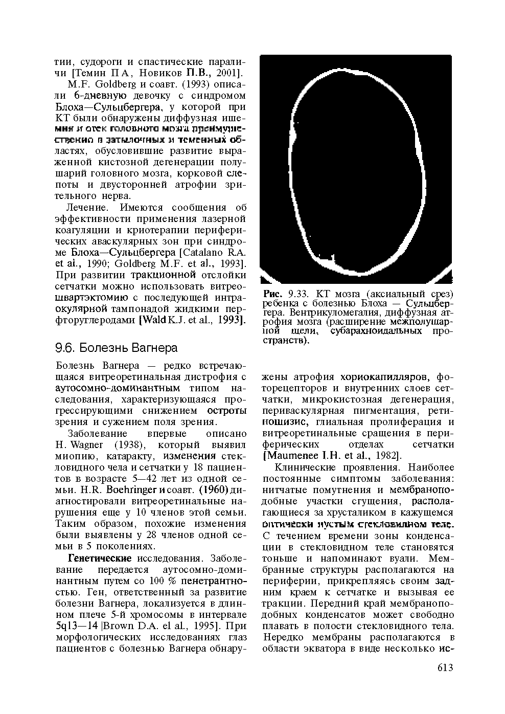 Рис. 9.33. КТ мозга (аксиальный срез) ребенка с болезнью Блоха — Сульцбергера. Вентрикуломегалия, диффузная атрофия мозга (расширение межполушарной щели, субарахноидальных пространств).