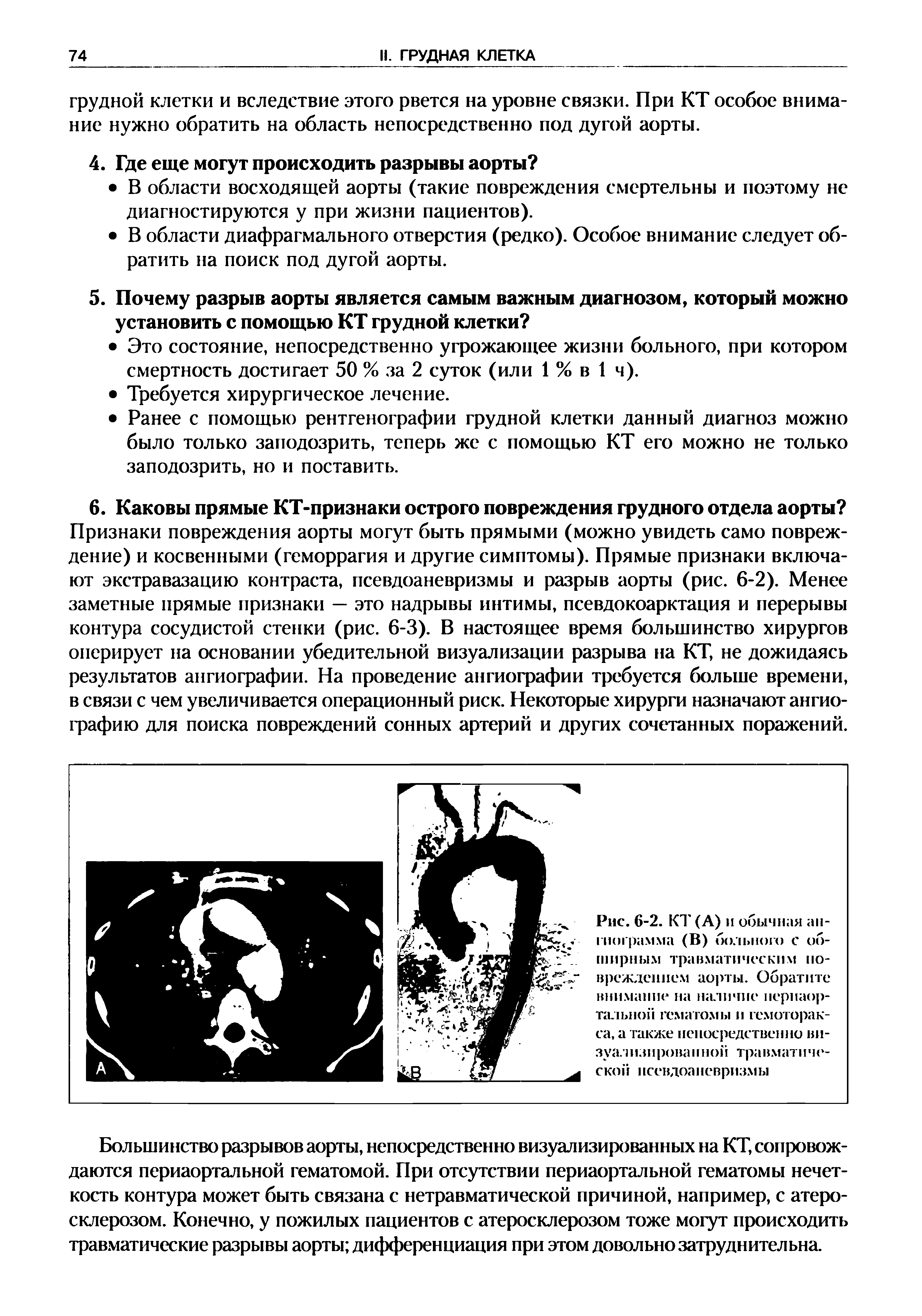 Рис. 6-2. КТ (А) и обычная ангиограмма (В) больного с обширным травматическим повреждением аорты. Обратите внимание на наличие периаор-тальной гематомы и гемоторакса, а также непосредственно визуализированной травматической нсевдоаневризмы...