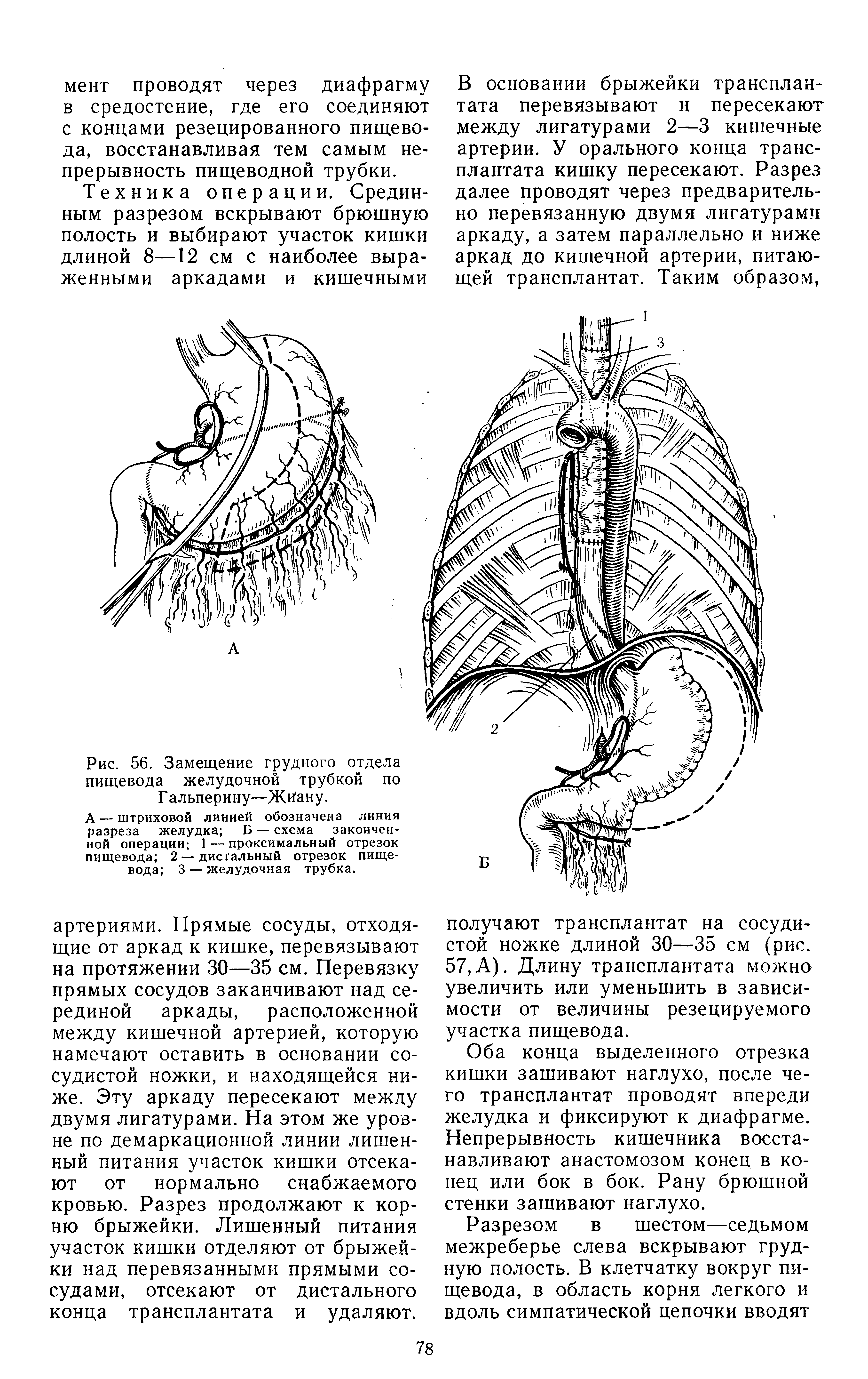 Рис. 56. Замещение грудного отдела пищевода желудочной трубкой по Г альперину—Жйану.