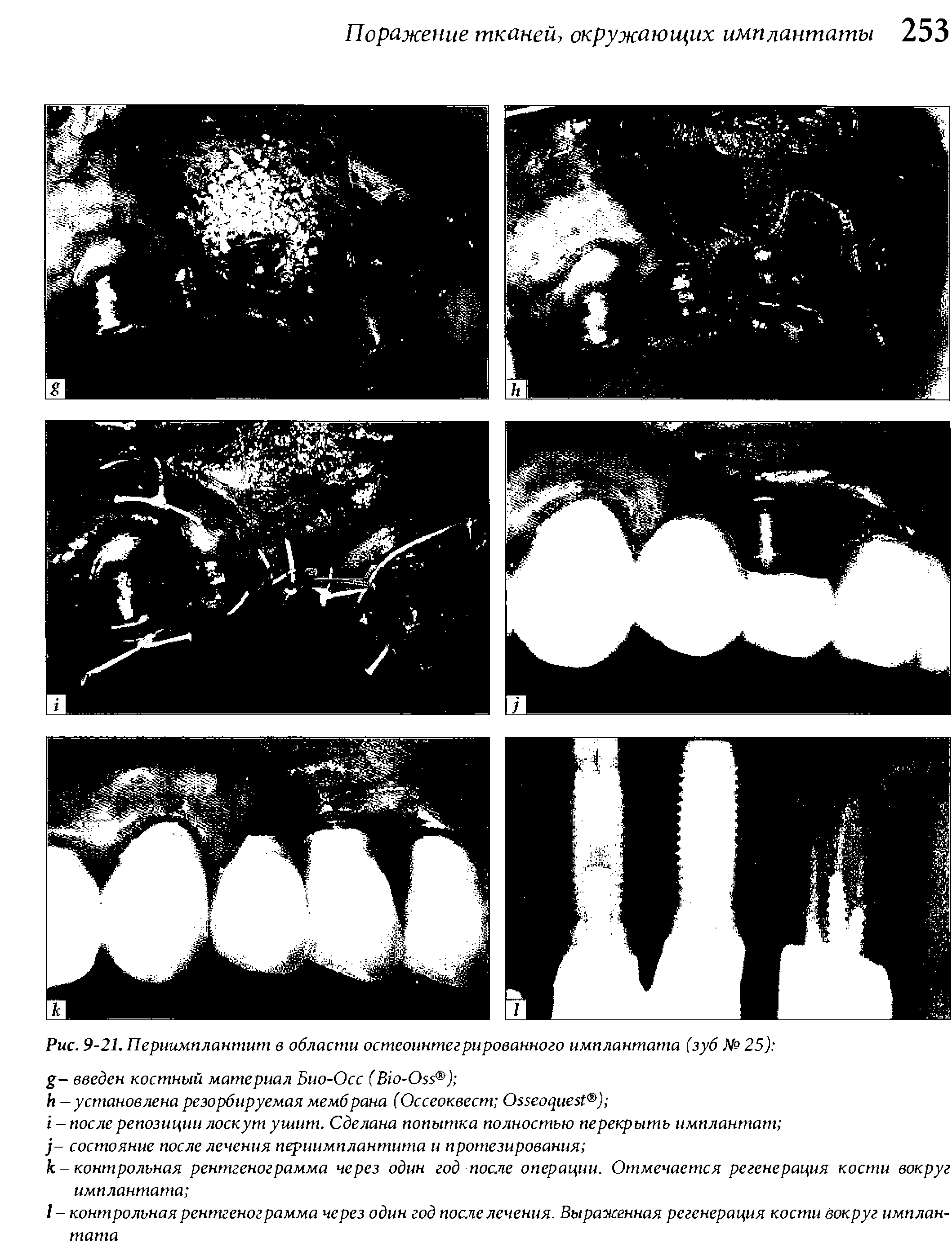 Рис. 9-21. Периимплантит в области остеоинтегрированного имплантата (зуб №25) - введен костный материал Био-Осс (B -O ) ...