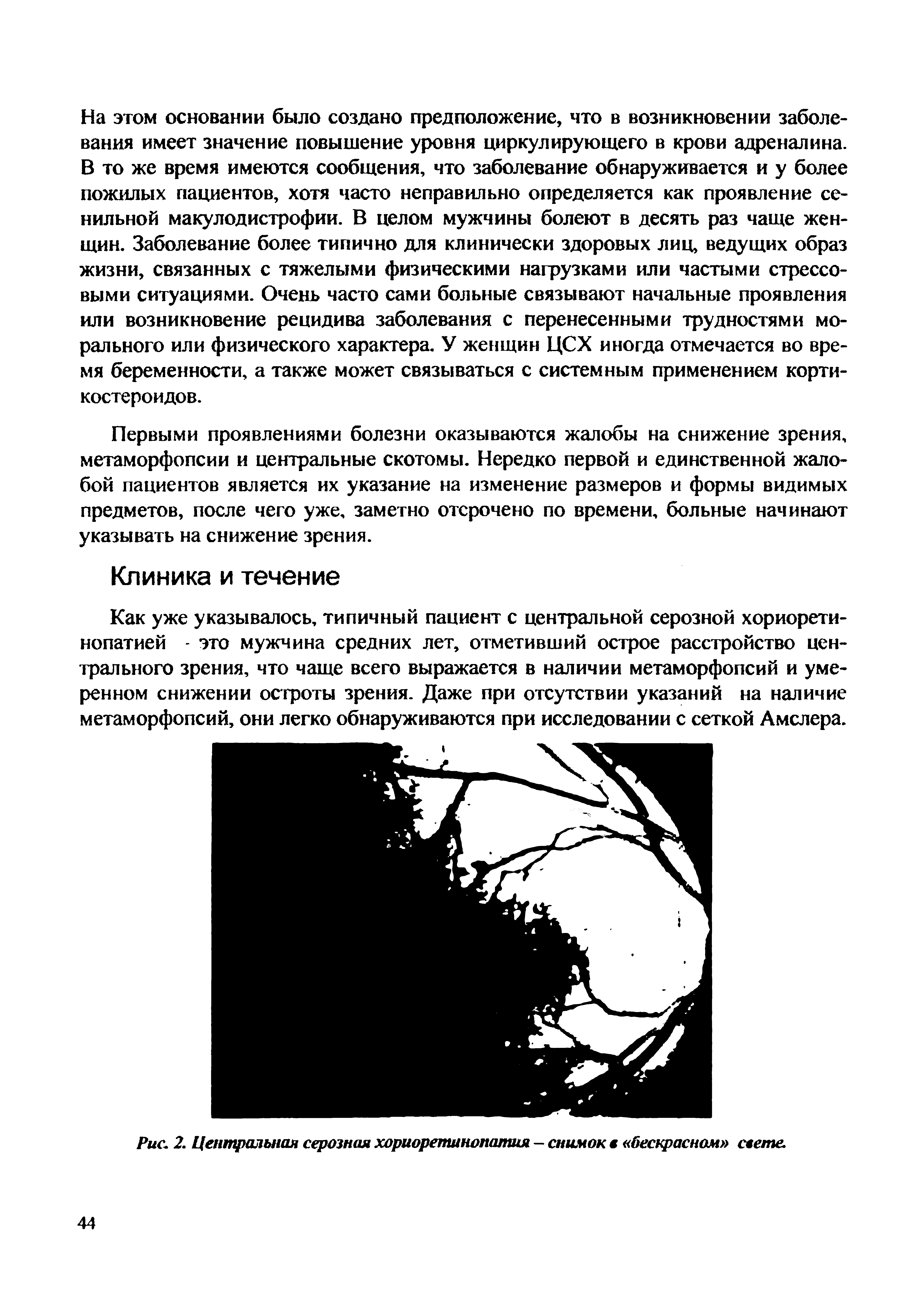 Рис. 2. Центральная серозная хориоретинопатия — снимок в бескрасном свете.