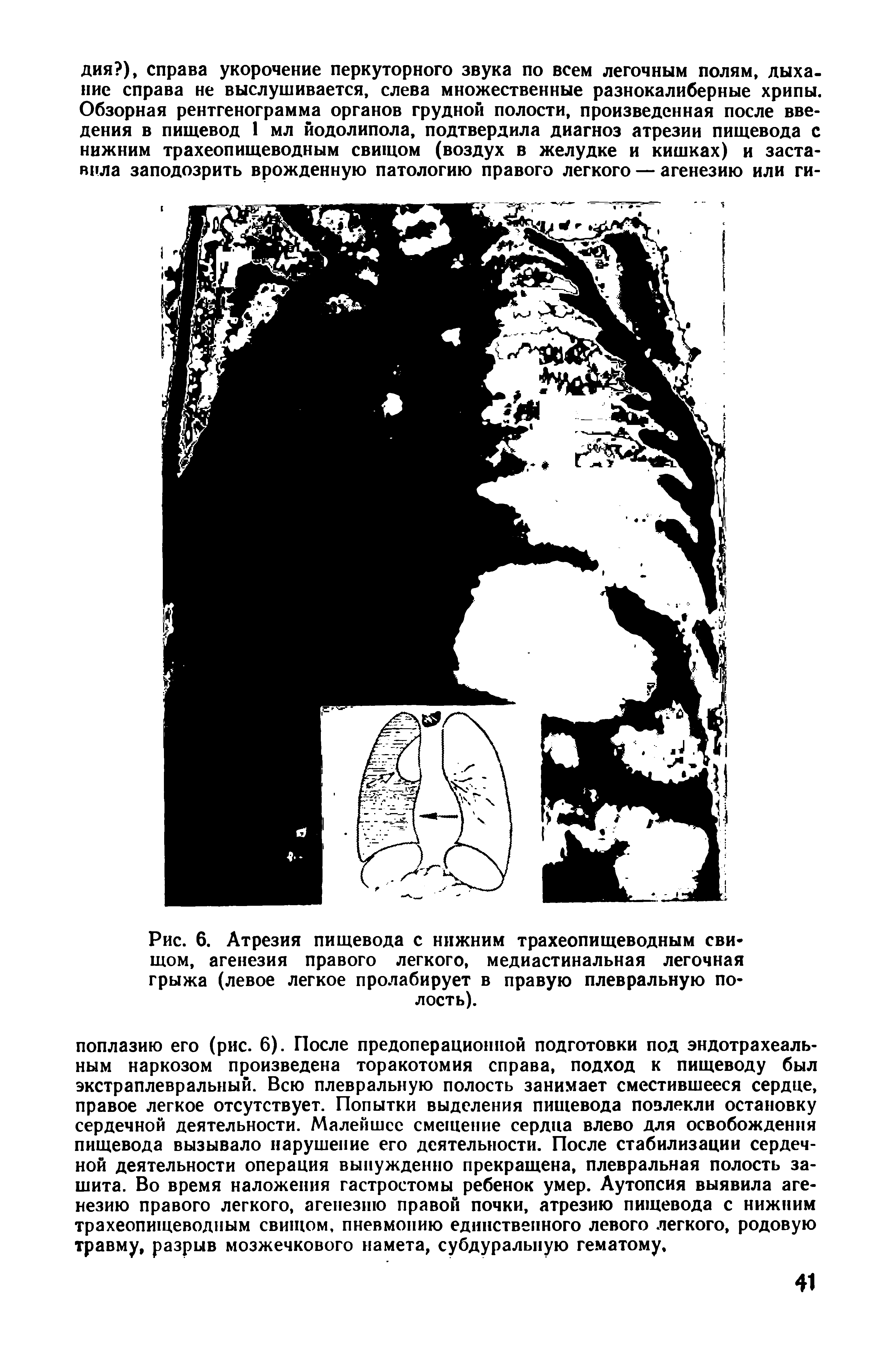 Рис. 6. Атрезия пищевода с нижним трахеопищеводным свищом, агенезия правого легкого, медиастинальная легочная грыжа (левое легкое пролабирует в правую плевральную полость).