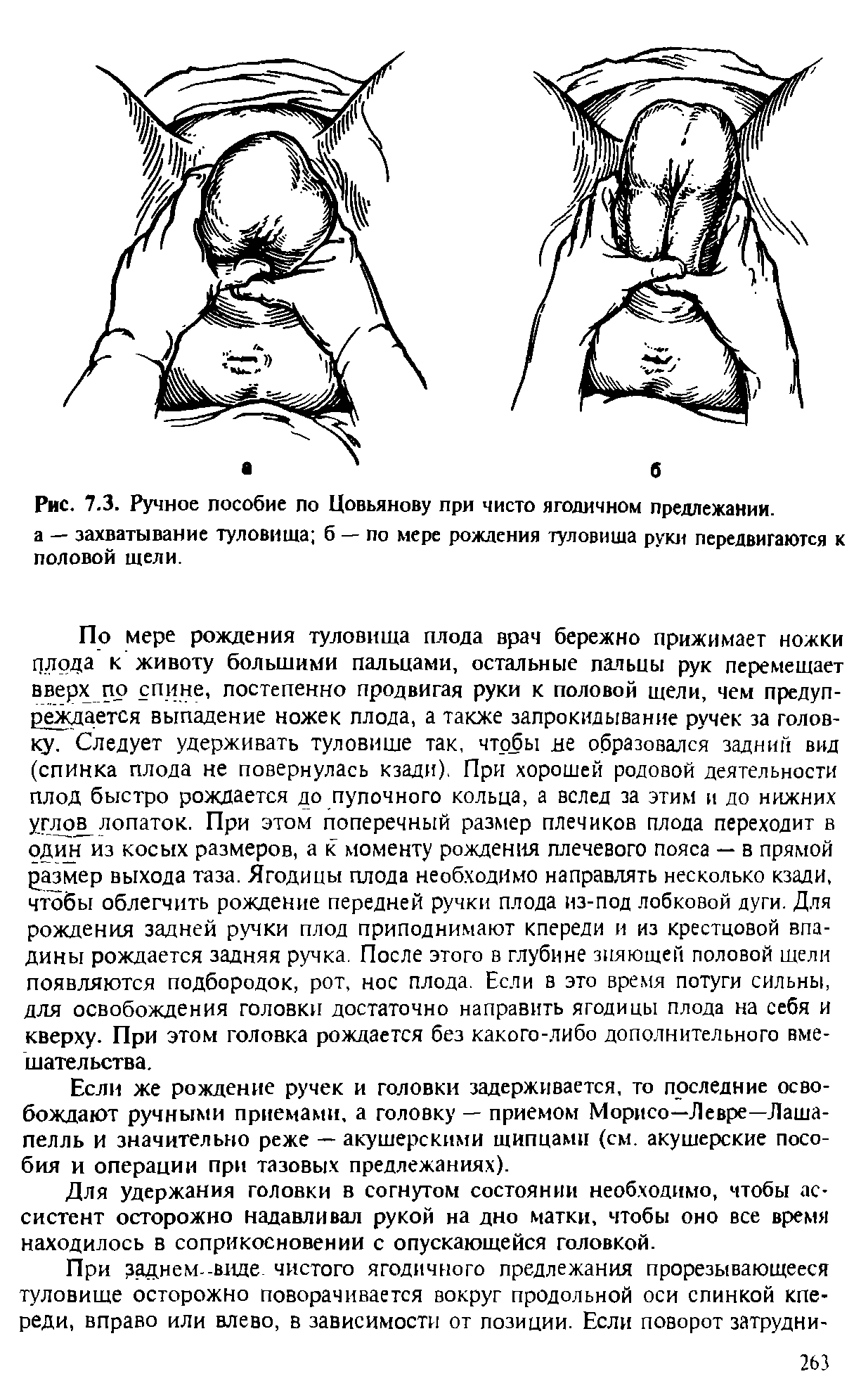 Рис. 7.3. Ручное пособие по Цовьянову при чисто ягодичном предлежании.