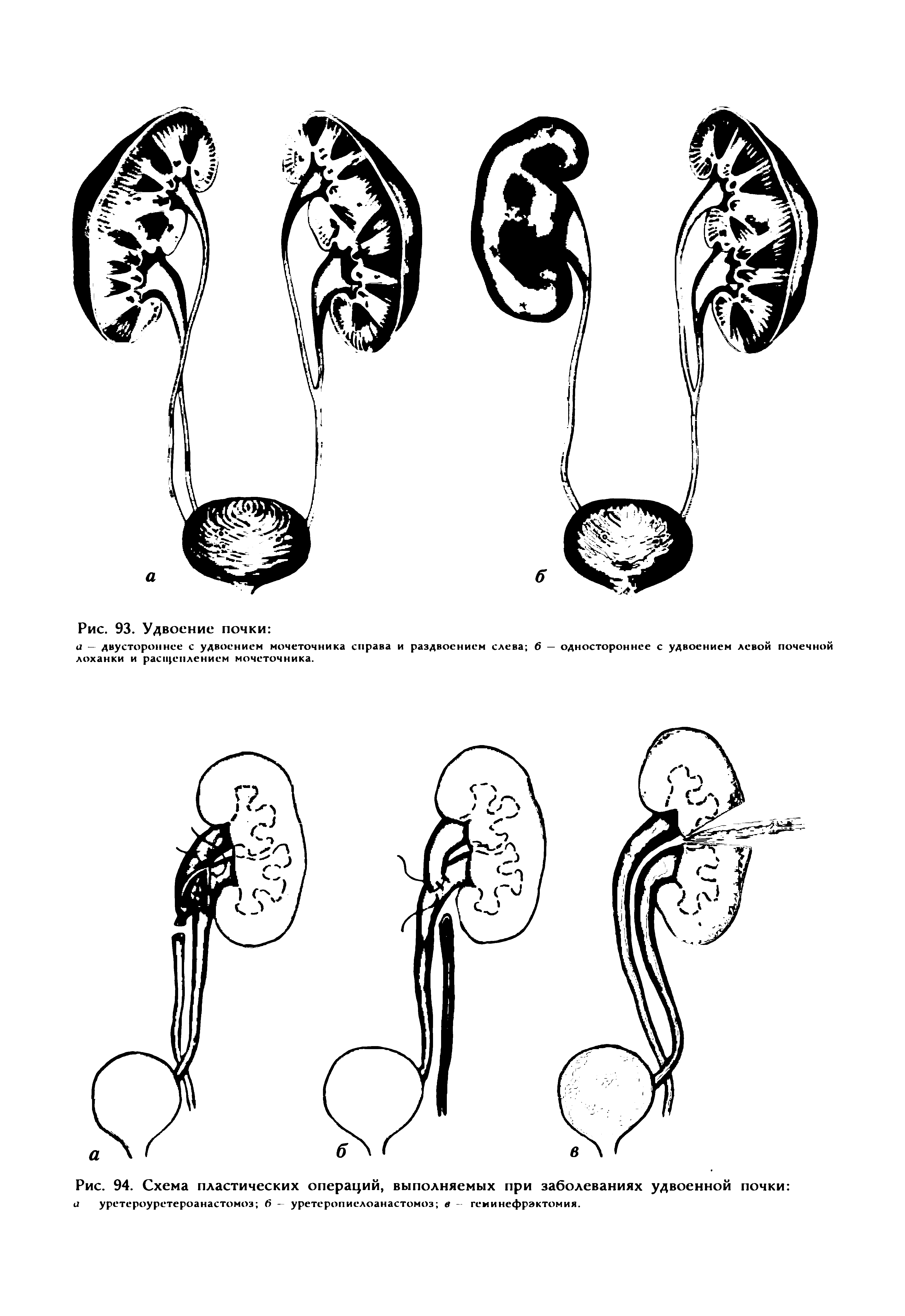 Рис. 94. Схема пластических операций, выполняемых при заболеваниях удвоенной почки а уретероуретероанастомоз б - уретеропиелоанастомоз в - геминефрэктомия.