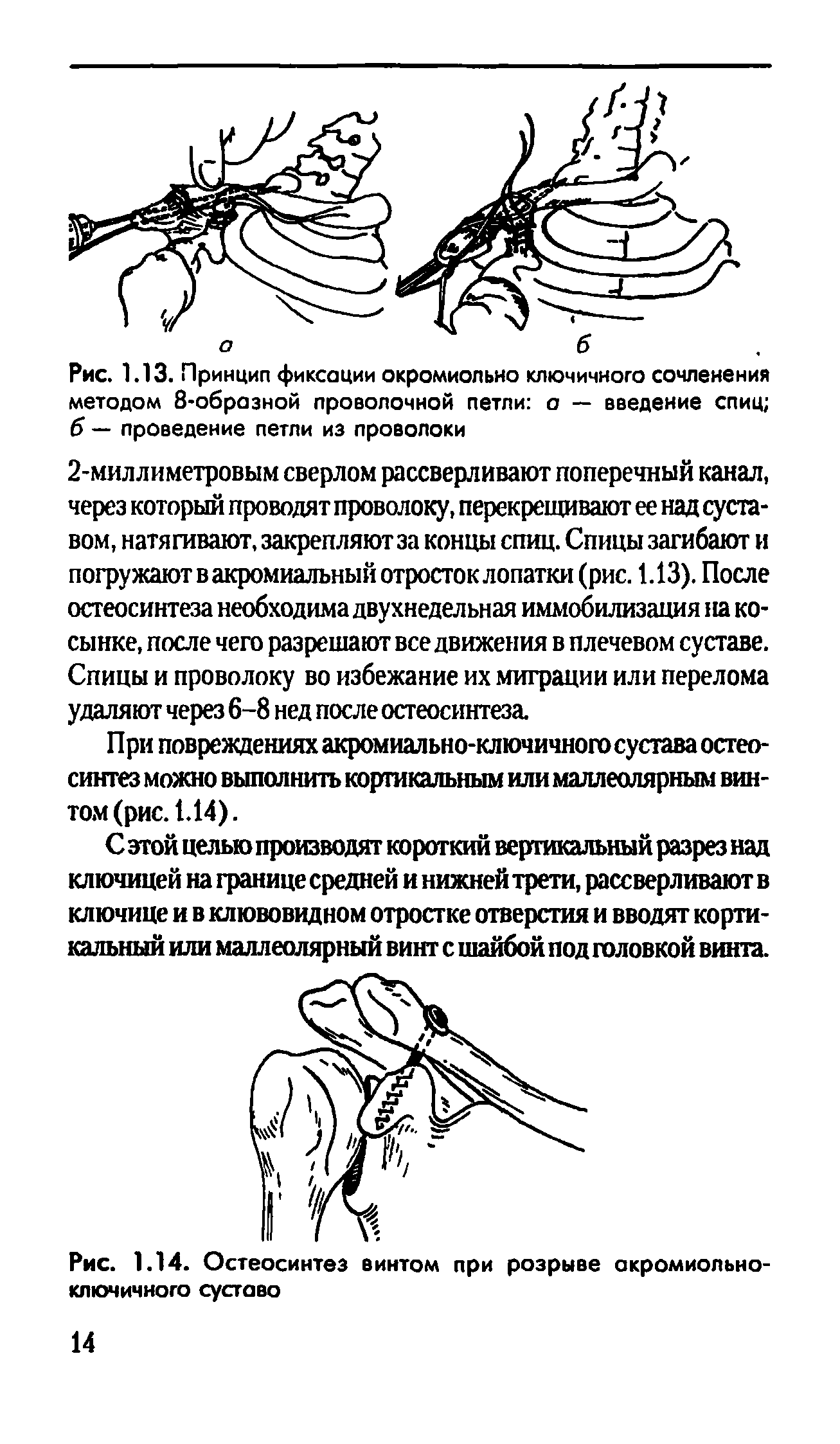 Рис. 1.14. Остеосинтез винтом при розрыве акромиольно-ключичного суставо...