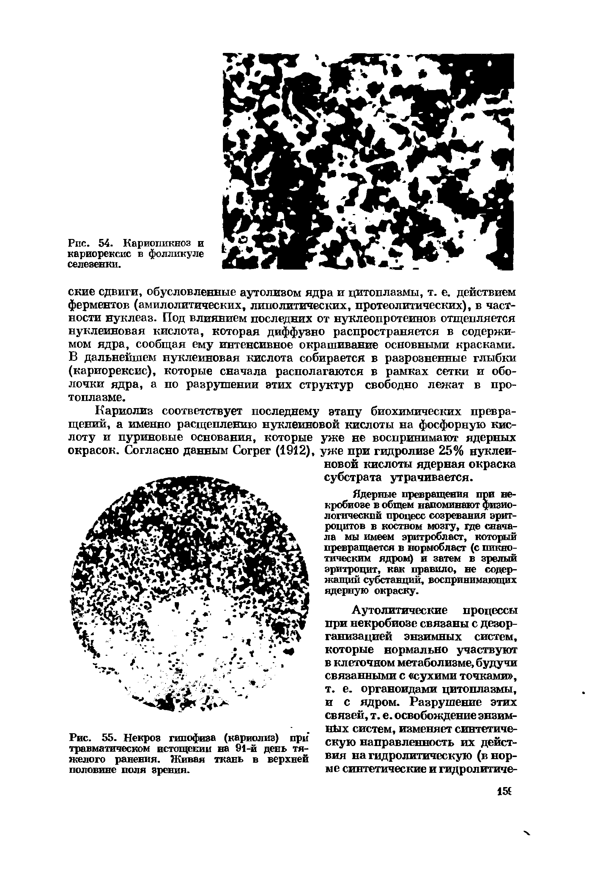 Рис. 55. Некроз гипофиза (кариолиз) при травматическом истощении на 91-й день тяжелого ранения. Живая ткань в верхней половине поля зрения.