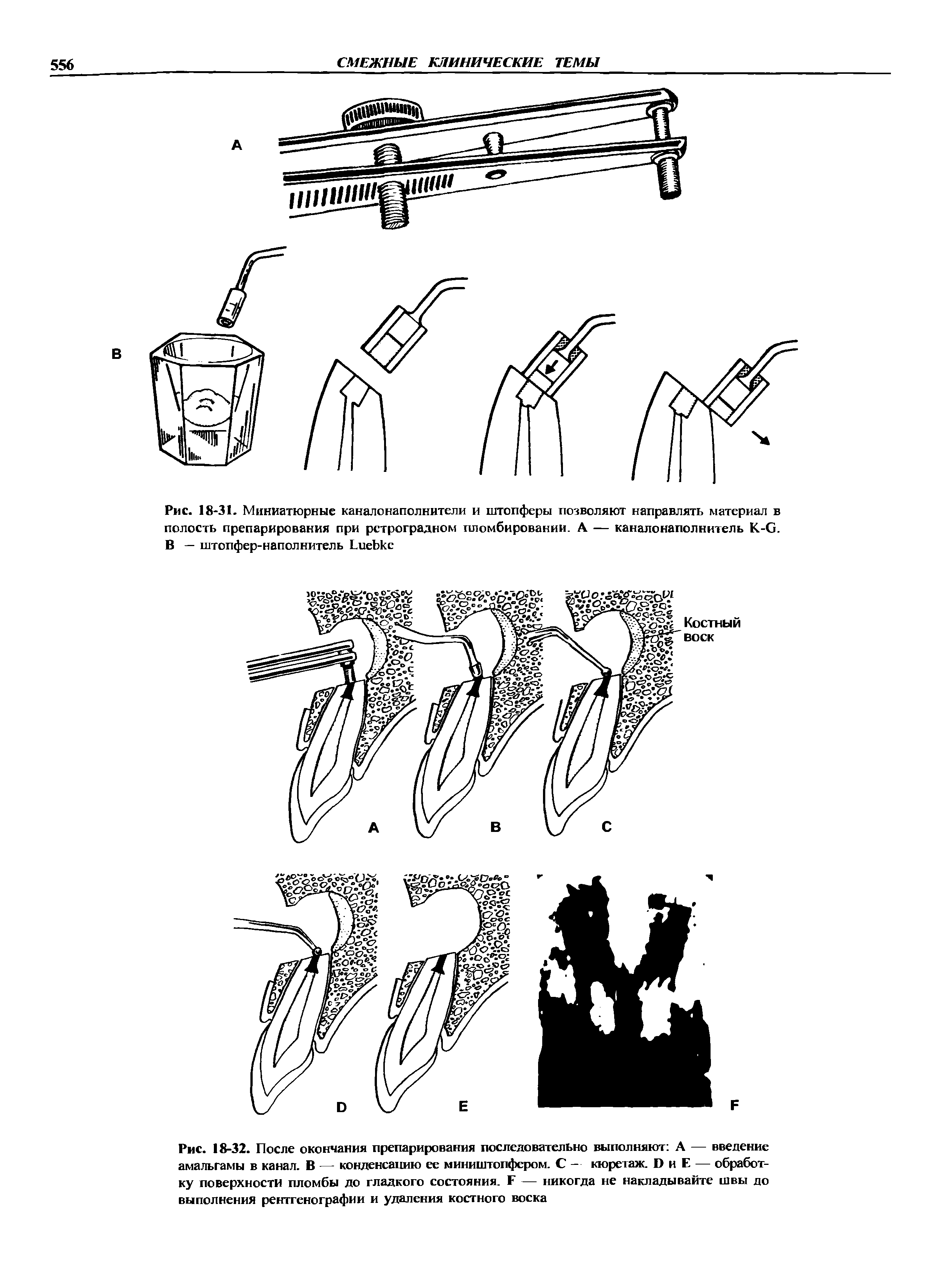 Рис. 18-32. После окончания препарирования последовательно выполняют А — введение амальгамы в канал. В — конденсацию ее миништопфером. С - кюретаж. I) и Е — обработку поверхности пломбы до гладкого состояния. Г — никогда не накладывайте швы до выполнения рентгенографии и удаления костного воска...