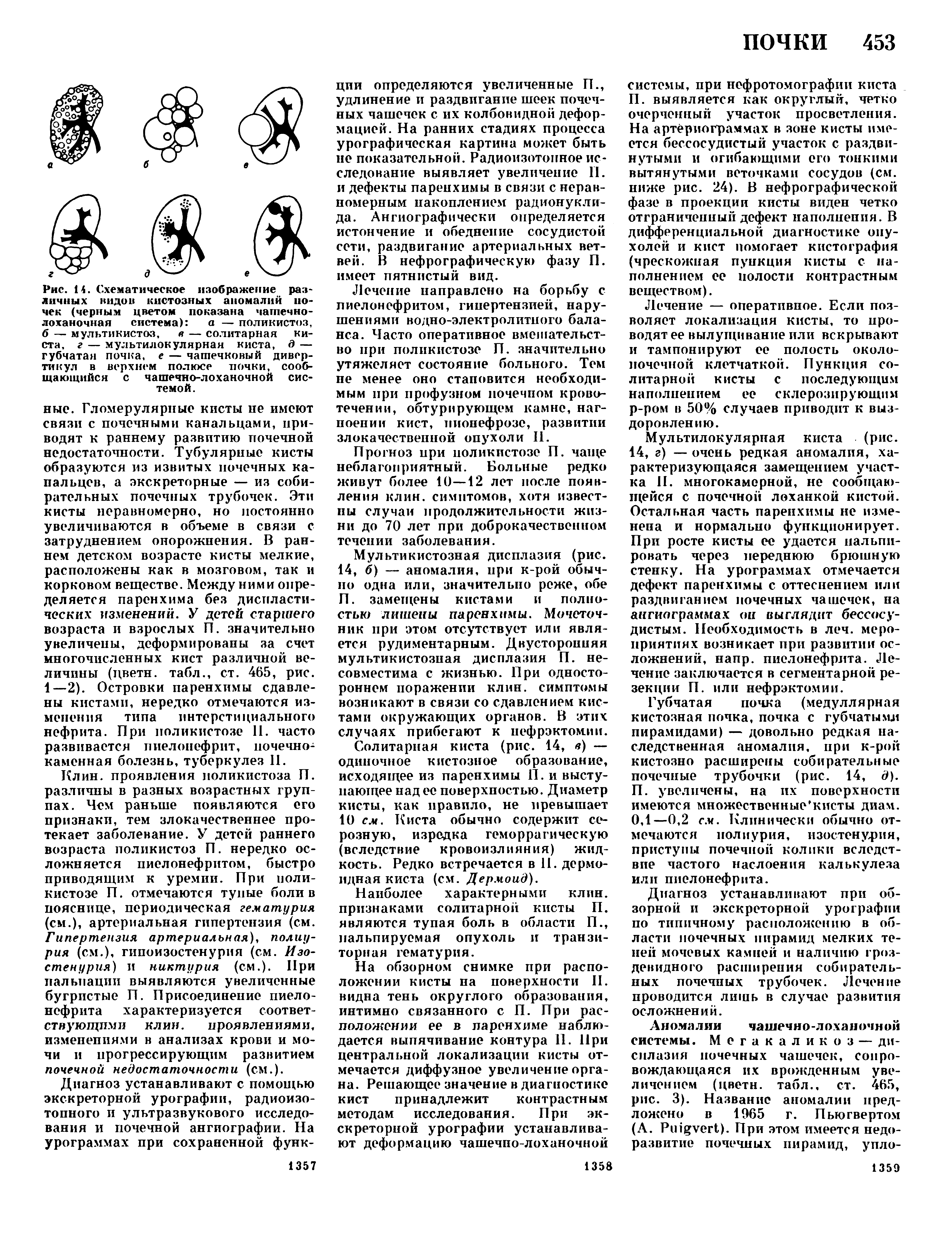 Рис. 14. Схематическое изображение различных видов кистозных аномалий ночек (черным цветом показана чашечнолоханочная система) а — поликистоз, б — мультикистоз, в — солитарная киста, г — мультилокулярная киста, 0 — губчатая почка, е — чашечковый дивертикул в верхнем полюсе почки, сообщающийся с чашечно-лоханочной системой.