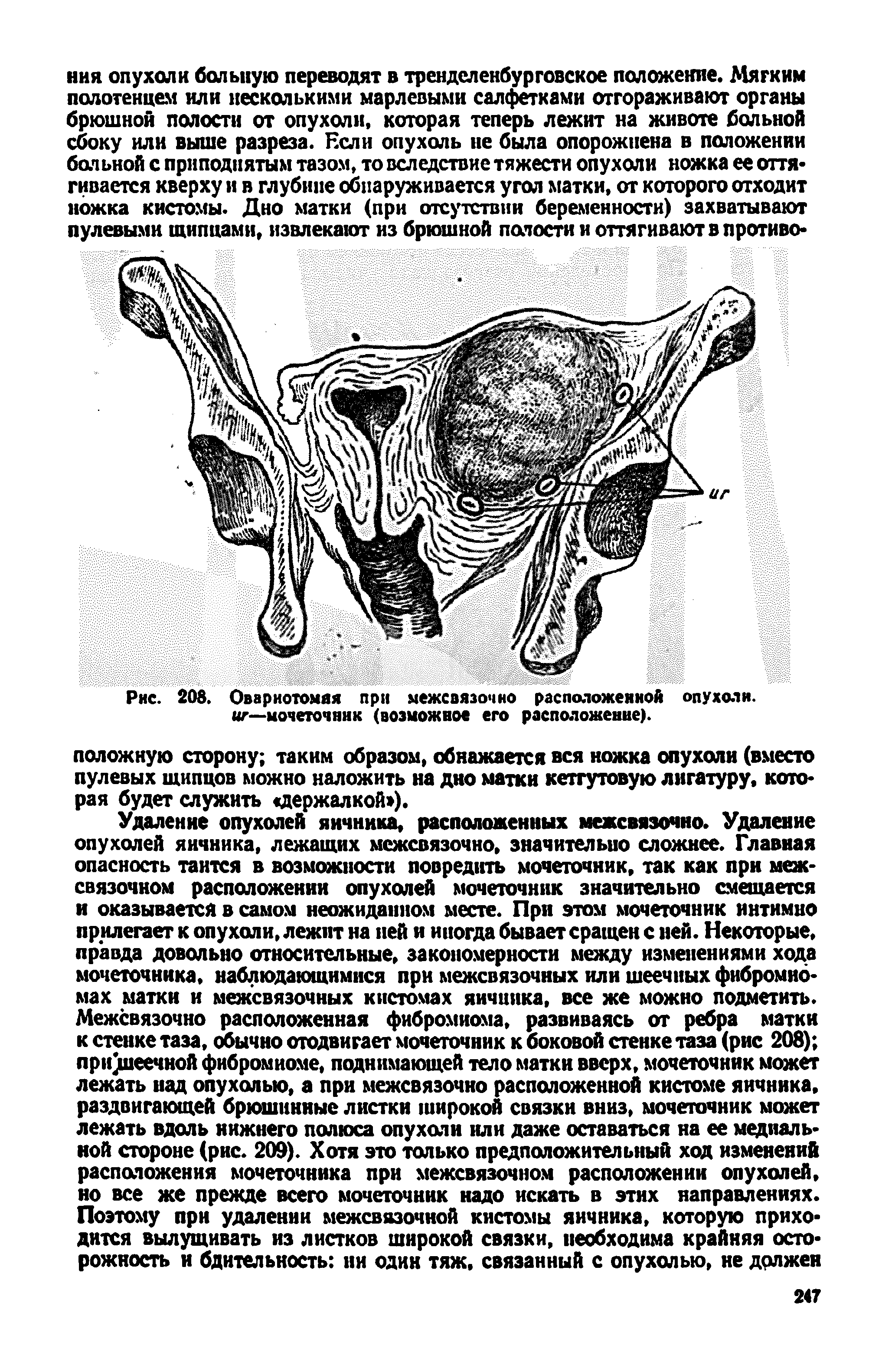 Рис. 208. Овариотомия при межсвязочно расположенной опухоли, иг—мочеточник (возможное его расположение).