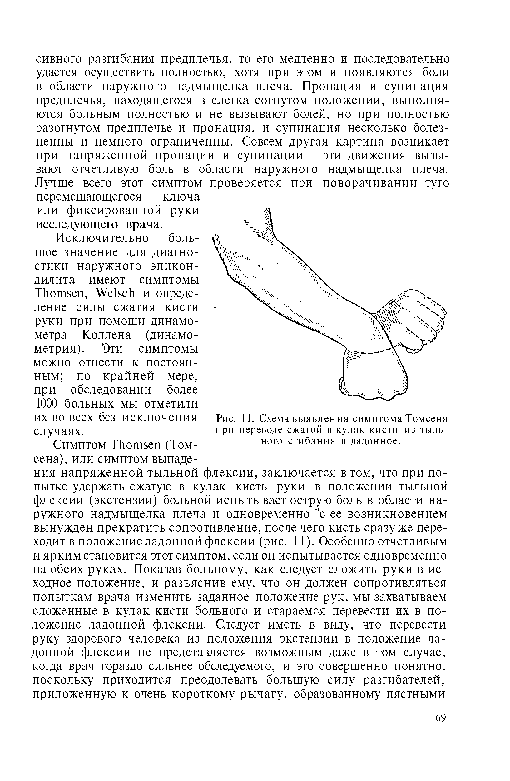 Рис. 11. Схема выявления симптома Томсена при переводе сжатой в кулак кисти из тыльного сгибания в ладонное.